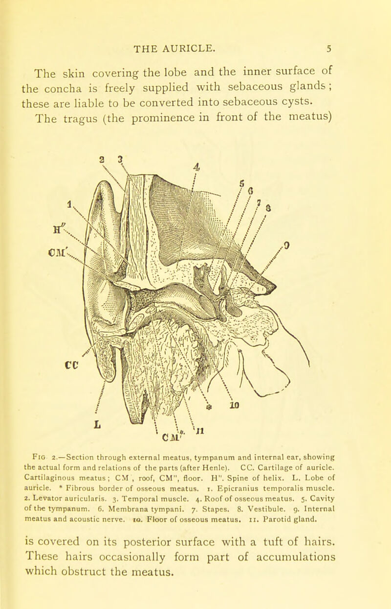 The skin covering the lobe and the inner surface of the concha is freely supplied with sebaceous glands; these are liable to be converted into sebaceous cysts. The tragus (the prominence in front of the meatus) Fig 2.—Section through external meatus, tympanum and internal ear, showing the actual form and relations of the parts (after Henle). CC. Cartilage of auricle. Cartilaginous meatus; CM , roof, CM, floor. H. Spine of helix. L. Lobe of auricle. * Fibrous border of osseous meatus, i. Epicranius temporalis muscle. 2. Levator auricularis. 3. Temporal muscle. 4. Roof of osseous meatus. 5. Cavity of the tympanum. 6. Membrana tympani. 7. Stapes. 8. Vestibule, g. Internal meatus and acoustic nerve. 10. Floor of osseous meatus. 11. Parotid gland. is covered on its posterior surface with a tuft of hairs. These hairs occasionally form part of accumulations which obstruct the meatus.