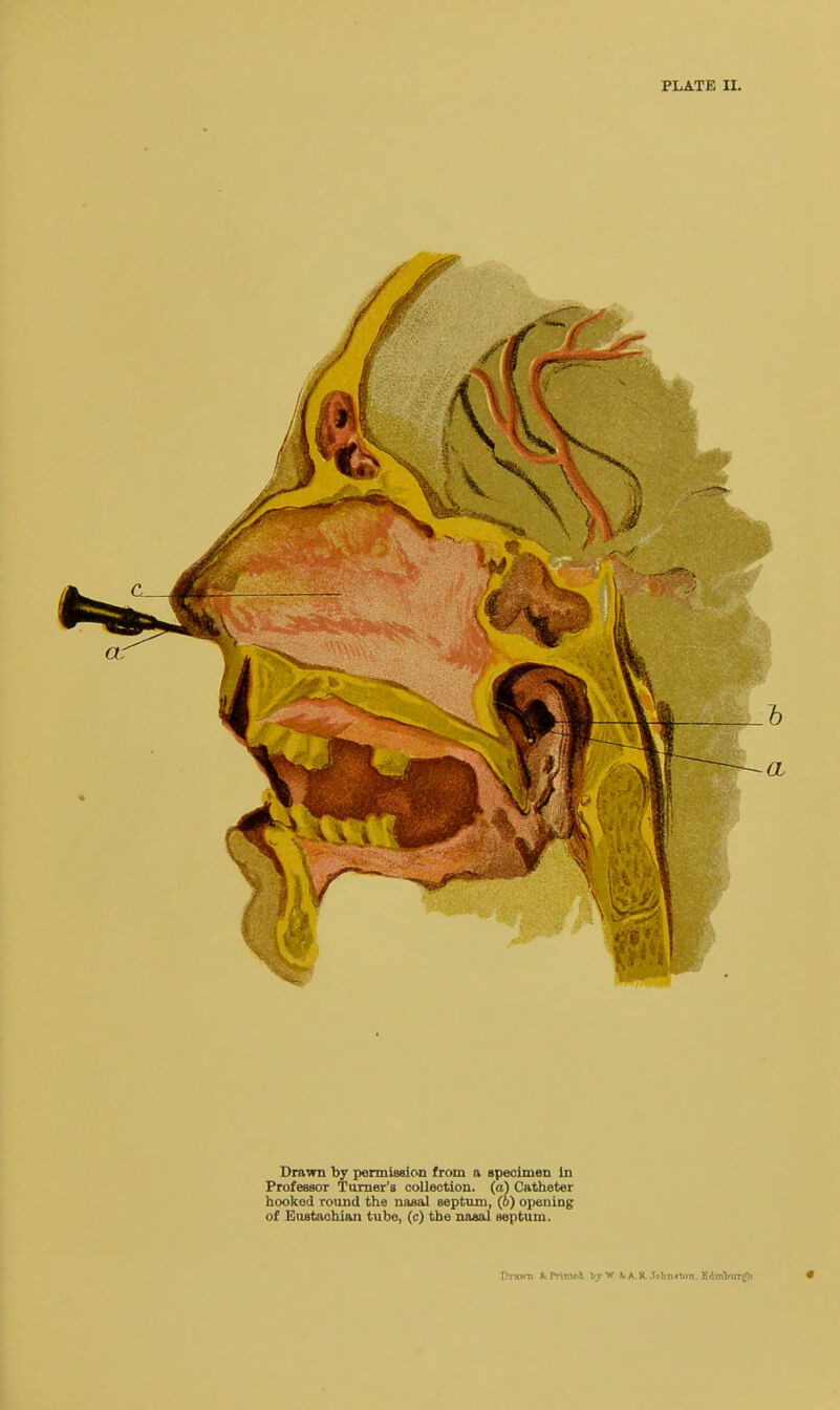 Drawn by permission from a specimen In Professor Turner's collection, (a) Catheter hooked round the nasal septum, (o) opening of Eustachian tube, (c) the nasal septum. Drawn fc Prime.1 tjrW V A K JohmMn EAmVurjfh •