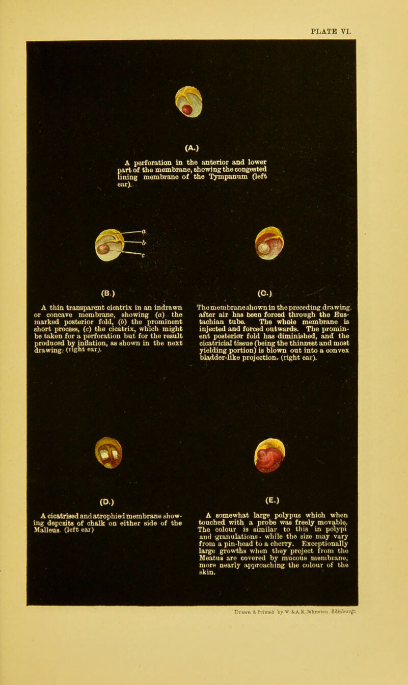 A perforation in the anterior and lower part of the membrane, Bhowing the congested lining membrane of the Tympanum (left ear). A thin transparent cicatrix in an indrawn or concave membrane, showing (a) the marked posterior fold, (6) the prominent short process, (c) the cicatrix, which might be taken for a perforation but for the result produced by inflation, as shown in the next drawing, (right earj. Thomembrane3hownin the preceding drawing, after air has been forced through the Eus- tachian tube. The whole membrane is injected and forced outwards. The promin- ent posterior fold has diminished, and the cicatricial tissue (being the thinnest and most yielding portion) is blown out into a convex bladder-like projection, (right ear). A cicatrised and atrophied membrane show- ing deposits of chalk on either side of the Malleus (left ear) A somewhat large polypus which when touched with a probe was freely movable. The colour is similar to this in polypi and granulations- while tho size may vary from a pin-head to a cherry. Exceptionally large growths when tliuy project from the Meatus are covered by mucous membrane, more nearly approaching the colour of the skin. ■Drawn It Printed b;y W fcA.K-Min-ton Eiiirt)Ur£: