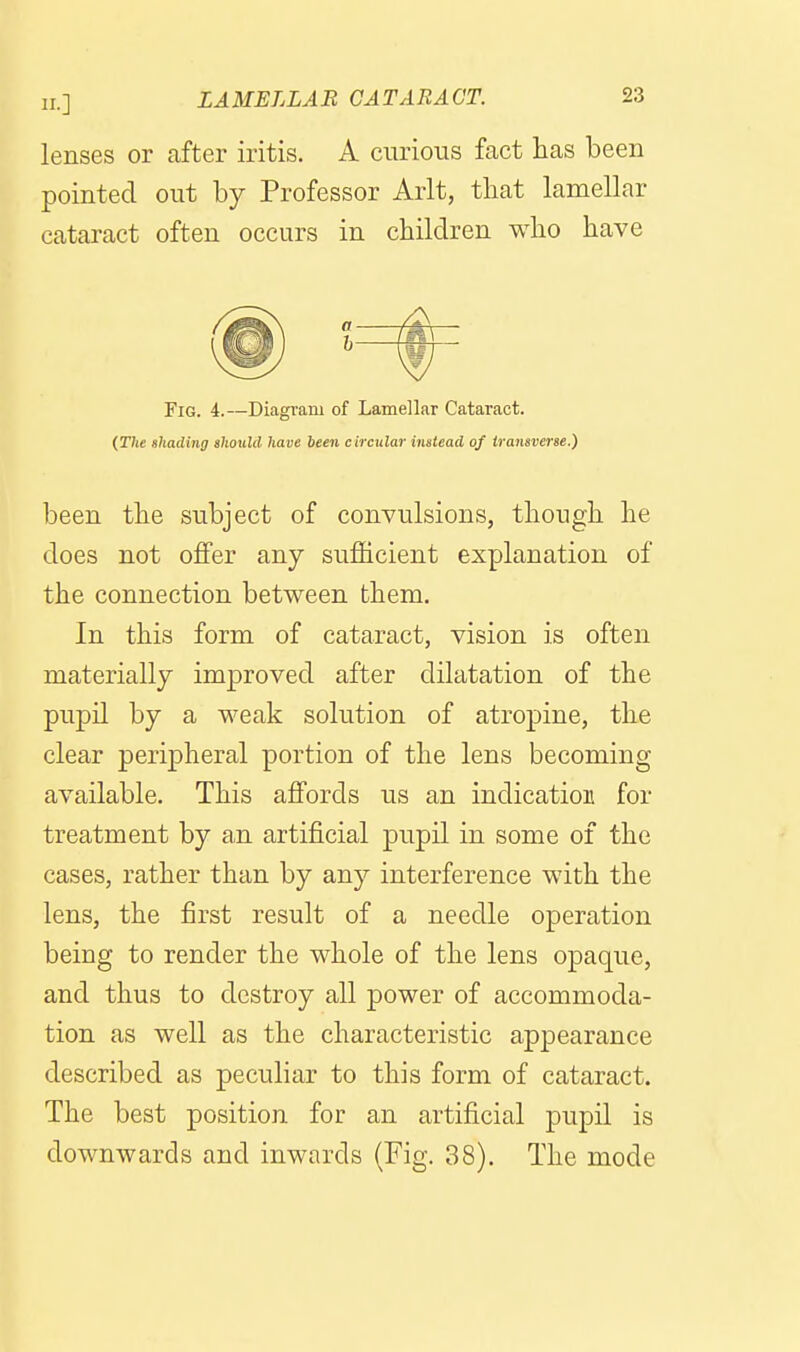 lenses or after iritis. A curious fact has been pointed out by Professor Arlt, that lamellar cataract often occurs in children who have Fig. 4.—Diagi'ani of Lamellar Cataract. (The shading should have been circular instead of transverse.) been the subject of convulsions, though he does not offer any sufficient explanation of the connection between them. In this form of cataract, vision is often materially improved after dilatation of the pupil by a weak solution of atropine, the clear peripheral portion of the lens becoming available. This affords us an indication for treatment by an artificial pupil in some of the cases, rather than by any interference with the lens, the first result of a needle operation being to render the whole of the lens opaque, and thus to destroy all power of accommoda- tion as well as the characteristic appearance described as peculiar to this form of cataract. The best position for an artificial pupil is downwards and inwards (Fig. 38). The mode