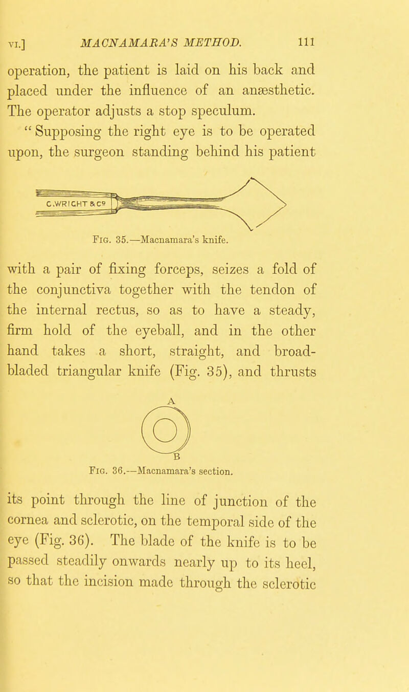 operation, the patient is laid on his back and placed under the influence of an anaesthetic. The operator adjusts a stop speculum.  Supposing the right eye is to be operated upon, the surgeon standing behind his patient Fig. 35.—Macnamara's knife. with a pair of fixing forceps, seizes a fold of the conjunctiva together with the tendon of the internal rectus, so as to have a steady, firm hold of the eyeball, and in the other hand takes a short, straight, and broad- bladed triangular knife (Fig. 35), and thrusts Fig. 36.—Macnamara's section. its point through the line of junction of the cornea and sclerotic, on the temporal side of the eye (Fig. 36). The blade of the knife is to be passed steadily onwards nearly up to its heel, so that the incision made through the sclerotic