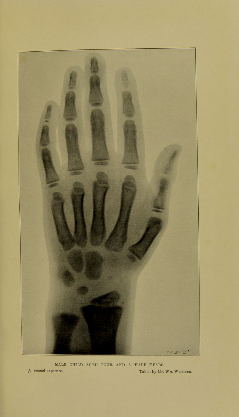 MALE CHILD AGED FOUR AND A HALF YEARS, second exposure. Taken by Mr. W.m. Wkbstkii.