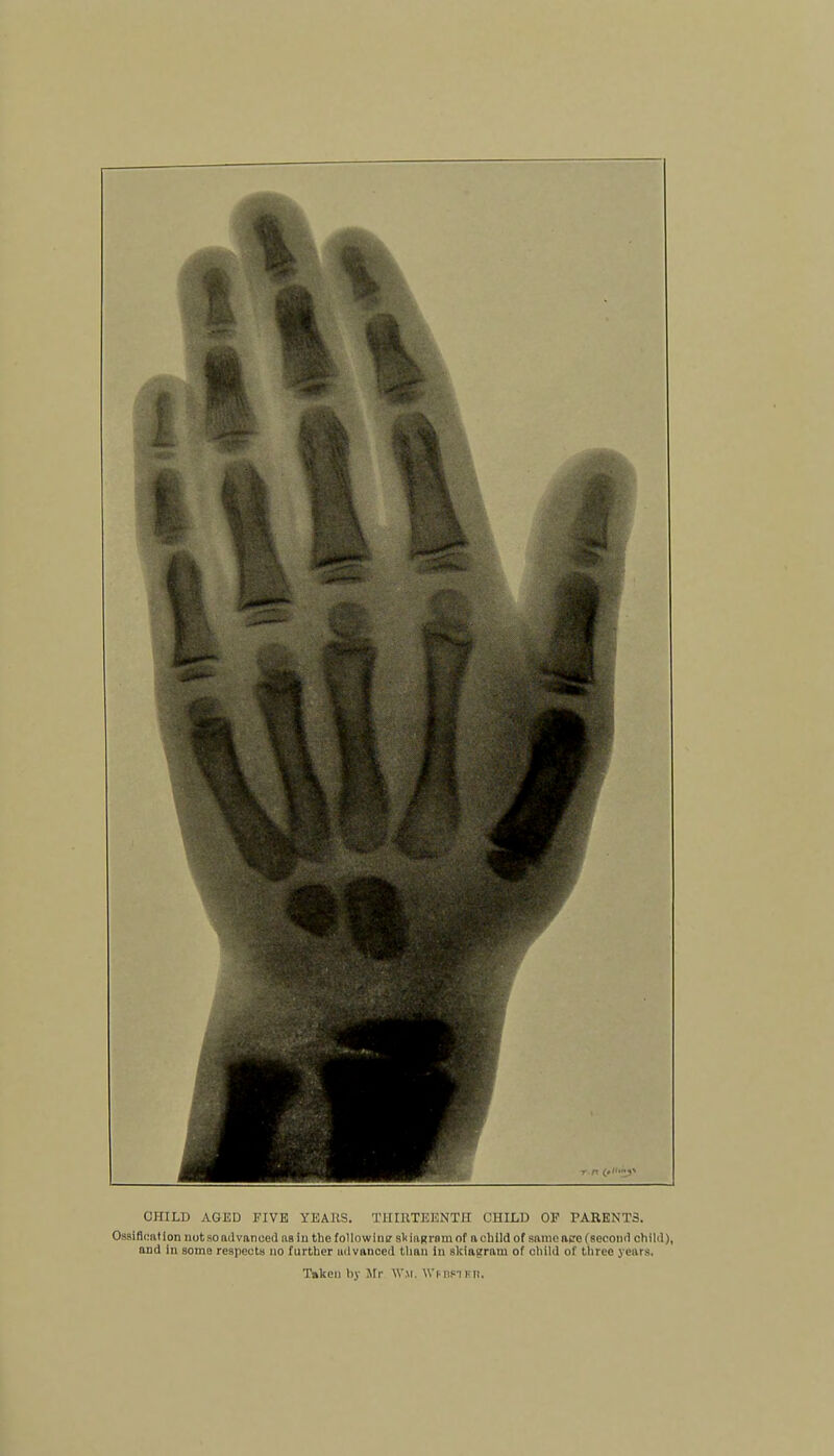 CHILD AGED FIVE YEAllS. THIRTEENTH CHILD OF PARENTS. Ossification not so advanced as in the followiiitr sl<iaKrom of a child of same ace (second child), ond in some respects no further advanced than in skiaeram of child of three years. Taken by Mr \V.\i. Wmfi I' ll.