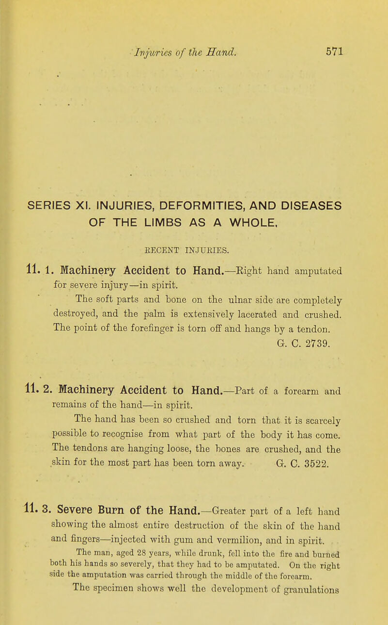 SERIES XI. INJURIES, DEFORMITIES, AND DISEASES OF THE LIMBS AS A WHOLE. KECENT INJURIES. 11. 1. Machinery Accident to Hand.—Eight hand amputated for severe injury—in spirit. The soft parts and bone on the ulnar side are completely- destroyed, and the palm is extensively lacerated and crushed. The point of the forefinger is torn off and hangs by a tendon. G. C. 2739. 11. 2. Machinery Accident to Hand.—Part of a forearm and remains of the hand—in spirit. The hand has been so crushed and torn that it is scarcely possible to recognise from what part of the body it has come. The tendons are hanging loose, the bones are crushed, and the skin for the most part has been torn away. G. C. 3522. 11. 3. Severe Burn of the Hand.—Greater part of a left hand showing the almost entire destruction of the skin of the hand and fingers—injected with gum and vermilion, and in spirit. The man, aged 28 years, while drunk, fell into the fire and burned both his hands so severely, that they had to be amputated. On the right side the amputation was carried through the middle of the forearm. The specimen shows well the development of granulations