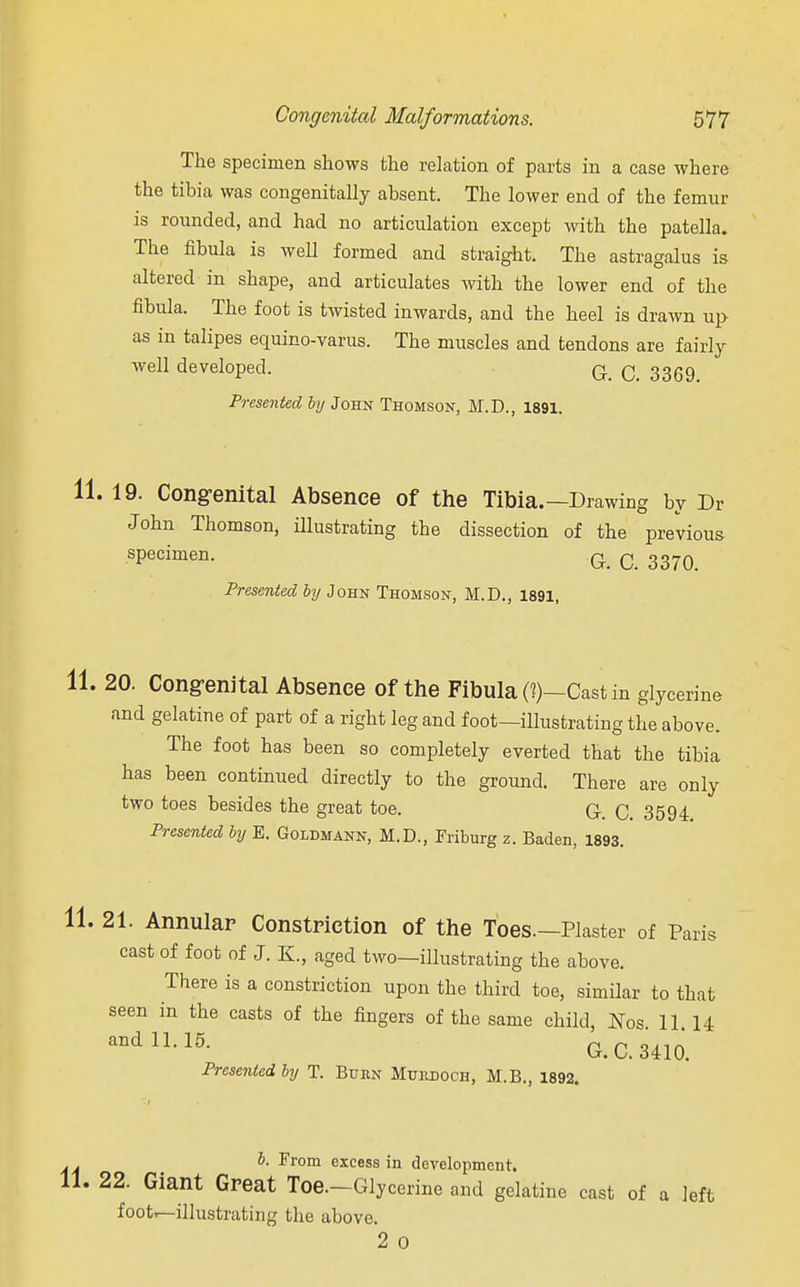 The specimen shows the relation of parts in a case where the tibia was congenially absent. The lower end of the femur is rounded, and had no articulation except with the patella. The fibula is well formed and straight. The astragalus is altered in shape, and articulates with the lower end of the fibula. The foot is twisted inwards, and the heel is drawn up as in talipes equino-varus. The muscles and tendons are fairly well developed. q q 3369_ Presented by John Thomson, M.D., 1891. 11. 19. Congenital Absence of the Tibia.—Drawing by Dr John Thomson, illustrating the dissection of the previous specimen. Q c 337a Presented by John Thomson, M.D., 1891, 11. 20. Congenital Absence of the Fibula (?)—Cast in glycerine and gelatine of part of a right leg and foot—illustrating the above. The foot has been so completely everted that the tibia has been continued directly to the ground. There are only two toes besides the great toe. q 3594 Presented by E. Goldmann, M.D., Friburg z. Baden, 1893. 11. 21. Annular Constriction of the Toes.—Plaster of Paris cast of foot of J. K, aged two—illustrating the above. There is a constriction upon the third toe, similar to that seen in the casts of the fingers of the same child, Nos 11 H andlL15- G.C.3410. Presented by T. Burn Murdoch, M.B., 1892. J- From excess in development. 11. 22. Giant Great Toe.—Glycerine and gelatine cast of a left foot—illustrating the above. 2 0