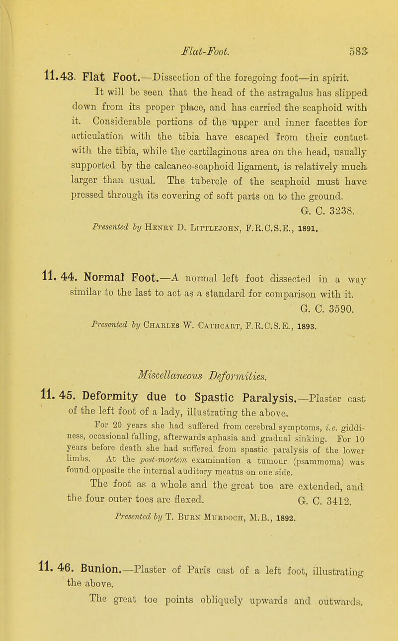 11.43. Flat Foot.—Dissection of the foregoing foot—inspirit. It will be seen that the head of the astragalus Las slipped down from its proper place, and has carried the scaphoid with it. Considerable portions of the upper and inner facettes for articulation with the tibia have escaped from their contact with the tibia, while the cartilaginous area on the head, usually- supported by the calcaneo-scaphoid ligament, is relatively much larger than usual. The tubercle of the scaphoid must have- pressed through its covering of soft parts on to the ground. G. C. 3238. Presented by Henry D. Littlejohn, F.R.C.S.E., 1891. 11. 44. Normal Foot.—A normal left foot dissected in a way similar to the last to act as a standard for comparison with it. G. C. 3590. Presented by Charles W. Cathoaut, F.R.C.S.E., 1893. Miscellaneous Deformities. 11. 45. Deformity due to Spastic Paralysis.—Plaster cast of the left foot of a lady, illustrating the above. For 20 years she had suffered from cerebral symptoms, i.e. giddi- ness, occasional falling, afterwards aphasia and gradual sinking. For 10 years before death she had suffered from spastic paralysis of the lower limbs. At the post-mortem examination a tumour (psammoma) was found opposite the internal auditory meatus on one side. The foot as a whole and the great toe are extended, and the four outer toes are flexed. G. C. 3412. Presented by T. Burn Murdoch, M.B., 1892. 11. 46. Bunion.—Plaster of Paris cast of a left foot, illustratino- the above. The great toe points obliquely upwards and outwards.