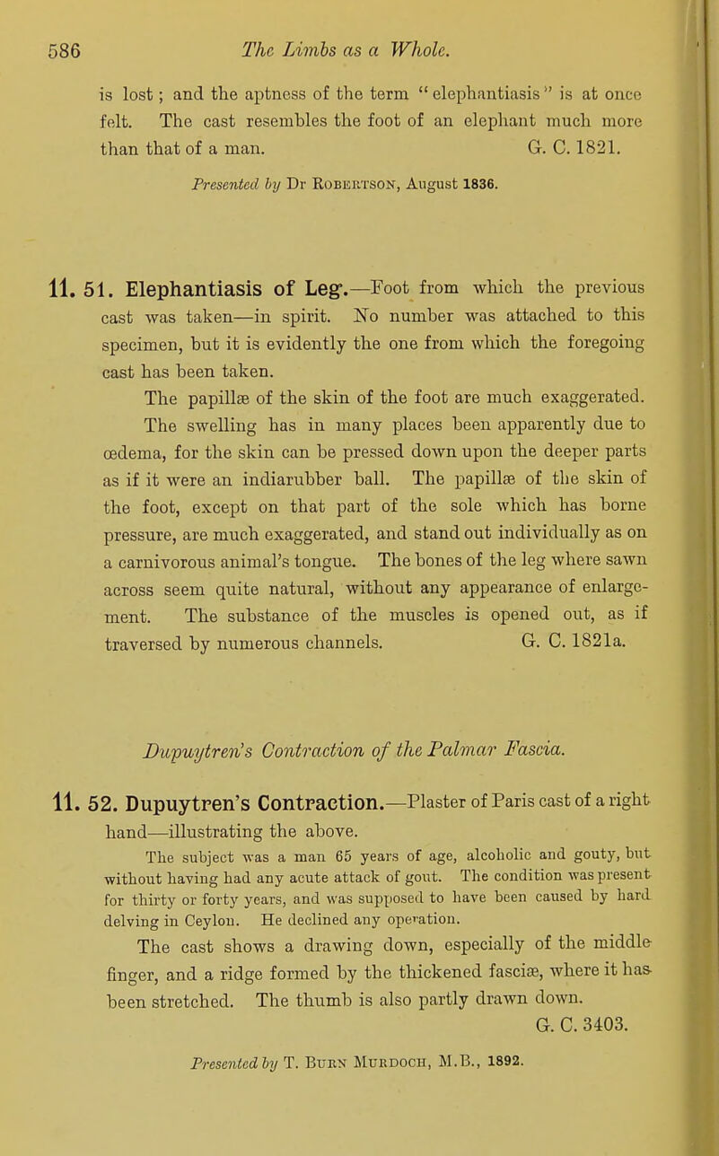 is lost; and the aptness of the term  elephantiasis  is at once felt. The cast resembles the foot of an elephant much more than that of a man. G. C. 1821. Presented by Dr Robertson, August 1836. 11. 51. Elephantiasis of Leg.—Foot from which the previous cast was taken—in spirit. No number was attached to this specimen, but it is evidently the one from which the foregoing cast has been taken. The papillae of the skin of the foot are much exaggerated. The swelling has in many places been apparently due to oedema, for the skin can be pressed down upon the deeper parts as if it were an indiarubber ball. The papilla? of the skin of the foot, except on that part of the sole which has borne pressure, are much exaggerated, and stand out individually as on a carnivorous animal's tongue. The bones of the leg where sawn across seem quite natural, without any appearance of enlarge- ment. The substance of the muscles is opened out, as if traversed by numerous channels. G. C. 1821a. Bupuytren's Contraction of the Palmar Fascia. 11. 52. Dupuytren's Contraction.—Plaster of Paris cast of a right hand—illustrating the above. The subject was a man 65 years of age, alcoholic and gouty, but without having had any acute attack of gout. The condition was present for thirty or forty years, and was supposed to have been caused by hard delving in Ceylon. He declined any operation. The cast shows a drawing down, especially of the middle finger, and a ridge formed by the thickened fascia?, where it has- been stretched. The thumb is also partly drawn down. G. C. 3403.