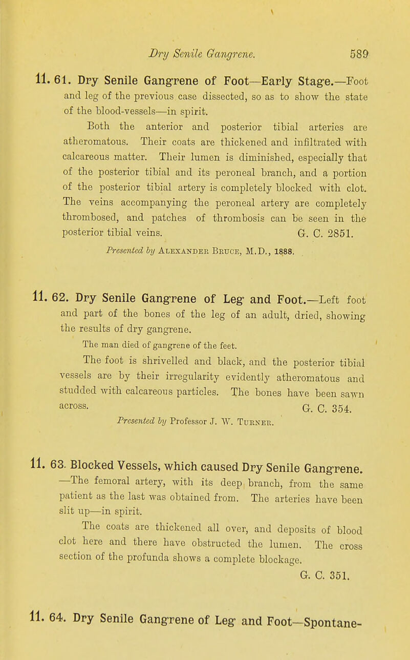 11.61. Dry Senile Gangrene of Foot—Early Stage.—Foot and leg of the previous case dissected, so as to show the state of the hlood-vessels—in spirit. Both the anterior and posterior tibial arteries are atheromatous. Their coats are thickened and infiltrated with calcareous matter. Their lumen is diminished, especially that of the posterior tibial and its peroneal branch, and a portion of the posterior tibial artery is completely blocked with clot. The veins accompanying the peroneal artery are completely thrombosed, and patches of thrombosis can be seen in the posterior tibial veins. G. C. 2851. Presented by Alexander Bruce, M.D., 1888. 11. 62. Dry Senile Gangrene of Leg and Foot.—Left foot and part of the bones of the leg of an adult, dried, showing the results of dry gangrene. The man died of gangrene of the feet. The foot is shrivelled and black, and the posterior tibial vessels are by their irregularity evidently atheromatous and studded with calcareous particles. The bones have been sawn across- G. C. 354. Presented by Professor J. W. Turner. 11. 63. Blocked Vessels, which caused Dry Senile Gangrene. —The femoral artery, with its deep branch, from the same patient as the last was obtained from. The arteries have been slit up—in spirit. The coats are thickened all over, and deposits of blood clot here and there have obstructed the lumen. The cross section of the profunda shows a complete blockage. G. C. 351. 11. 64. Dry Senile Gangrene of Leg and Foot-Spontane-