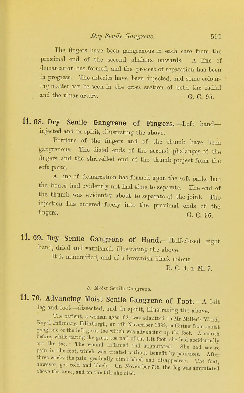 The fingers have been gangrenous in each case from the proximal end of the second phalanx onwards. A line of demarcation has formed, and the process of separation has been in progress. The arteries have been injected, and some colour- ing matter can be seen in the cross section of both the radial and the ulnar artery. G. C. 95. 68. Dry Senile Gangrene of Fingers.—Left hand- injected and in spirit, illustrating the above. Portions of the fingers and of the thumb have been gangrenous. The distal ends of the second phalanges of the fingers and the shrivelled end of the thumb project from the soft parts. A line of demarcation has formed upon the soft parts, but the bones had evidently not had time to separate. The end of the thumb was evidently about to separate at the joint. The injection has entered freely into the proximal ends of the finSers- G. C. 96. 69. Dry Senile Gangrene of Hand.—Half-closed right hand, dried and varnished, illustrating the above. It is mummified, and of a brownish black colour. B. C. 4. i. M. 7. b. Moist Senile Gangrene. 70. Advancing Moist Senile Gangrene of Foot.—A left leg and foot—dissected, and in spirit, iUustrating the above. The patient, a woman aged 62, was admitted to Mr Miller's Ward Eoyal Infirmary, Edinburgh, on 4th November 1889, suffering from moist gangrene of the left great toe which was advancing up the foot. A month before while paring the great toe nail of the left foot, she had accidentally cut the toe. ■ The wound inflamed and suppurated. She had severe pain in the foot, which was treated without benefit by poultices After three weeks the pain gradually diminished and disappeared The foot however, got cold and black. On November 7th the leg was amputated above the knee, and on the 9th she died.