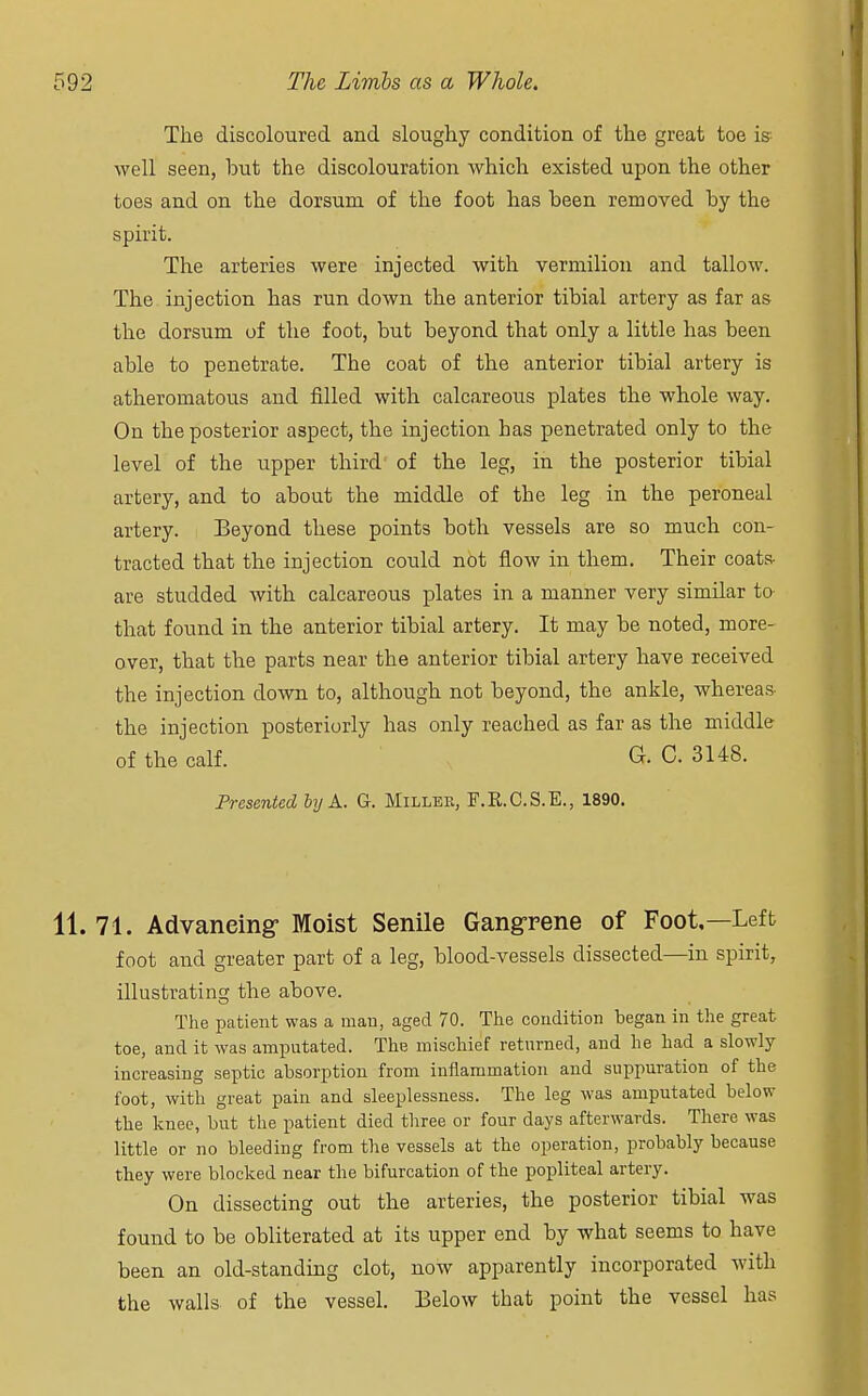 The discoloured and sloughy condition of the great toe is well seen, but the discolouration which existed upon the other toes and on the dorsum of the foot has been removed by the spirit. The arteries were injected with vermilion and tallow. The injection has run down the anterior tibial artery as far as the dorsum of the foot, but beyond that only a little has been able to penetrate. The coat of the anterior tibial artery is atheromatous and filled with calcareous plates the whole way. On the posterior aspect, the injection has penetrated only to the level of the upper third of the leg, in the posterior tibial artery, and to about the middle of the leg in the peroneal artery. Beyond these points both vessels are so much con- tracted that the injection could not flow in them. Their coats- are studded with calcareous plates in a manner very similar to that found in the anterior tibial artery. It may be noted, more- over, that the parts near the anterior tibial artery have received the injection down to, although not beyond, the ankle, whereas the injection posteriorly has only reached as far as the middle of the calf. G. C. 3148. Presented by A. G. Miller, F.R.C.S.E., 1890. 11. 71. Advancing- Moist Senile Gangrene of Foot.—Left foot and greater part of a leg, blood-vessels dissected—in spirit, illustrating the above. The patient was a man, aged 70. The condition began in the great toe, and it was amputated. The mischief returned, and he had a slowly increasing septic absorption from inflammation and suppuration of the foot, with great pain and sleeplessness. The leg was amputated below the knee, but the patient died three or four days afterwards. There was little or no bleeding from the vessels at the operation, probably because they were blocked near the bifurcation of the popliteal artery. On dissecting out the arteries, the posterior tibial was found to be obliterated at its upper end by what seems to have been an old-standing clot, now apparently incorporated with the walls of the vessel. Below that point the vessel has