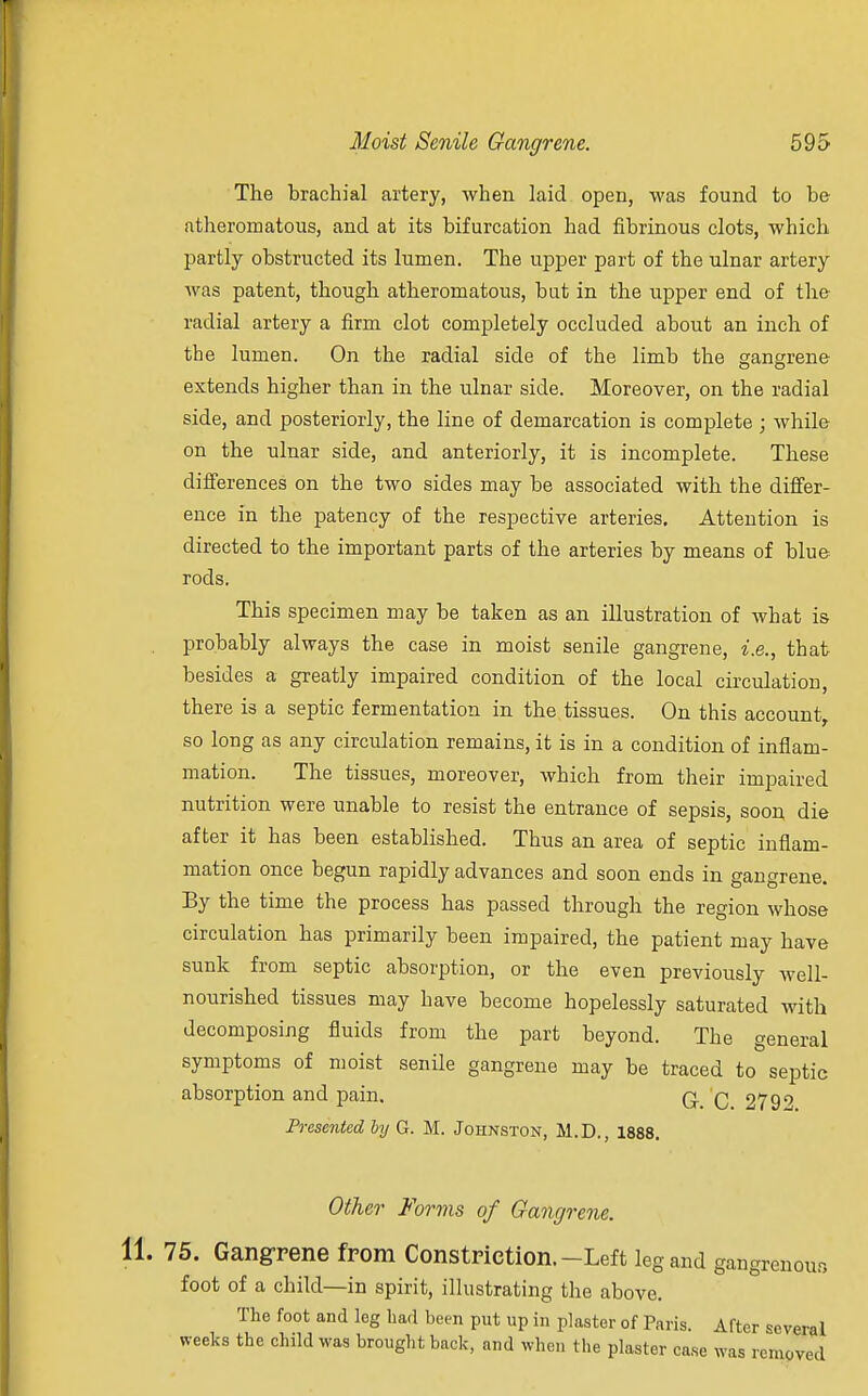 The brachial artery, when laid open, was found to be atheromatous, and at its bifurcation had fibrinous clots, which partly obstructed its lumen. The upper part of the ulnar artery was patent, though atheromatous, but in the upper end of the radial artery a firm clot completely occluded about an inch of the lumen. On the radial side of the limb the gangrene extends higher than in the ulnar side. Moreover, on the radial side, and posteriorly, the line of demarcation is complete ; while on the ulnar side, and anteriorly, it is incomplete. These differences on the two sides may be associated with the differ- ence in the patency of the respective arteries. Attention is directed to the important parts of the arteries by means of blue rods. This specimen may be taken as an illustration of what is probably always the case in moist senile gangrene, i.e., that besides a greatly impaired condition of the local circulation, there is a septic fermentation in the tissues. On this account, so long as any circulation remains, it is in a condition of inflam- mation. The tissues, moreover, which from their impaired nutrition were unable to resist the entrance of sepsis, soon die after it has been established. Thus an area of septic inflam- mation once begun rapidly advances and soon ends in gangrene. By the time the process has passed through the region whose circulation has primarily been impaired, the patient may have sunk from septic absorption, or the even previously well- nourished tissues may have become hopelessly saturated with decomposing fluids from the part beyond. The general symptoms of moist senile gangrene may be traced to septic absorption and pain. q. q 2790 Presented by G. M. Johnston, M.D., 1888. Other Forms of Gangrene. 75. Gangrene from Constriction.-Left leg and gangrenous foot of a child—in spirit, illustrating the above. The foot and leg had been put up in plaster of Paris. After several weeks the child was brought back, and when the plaster case was removed