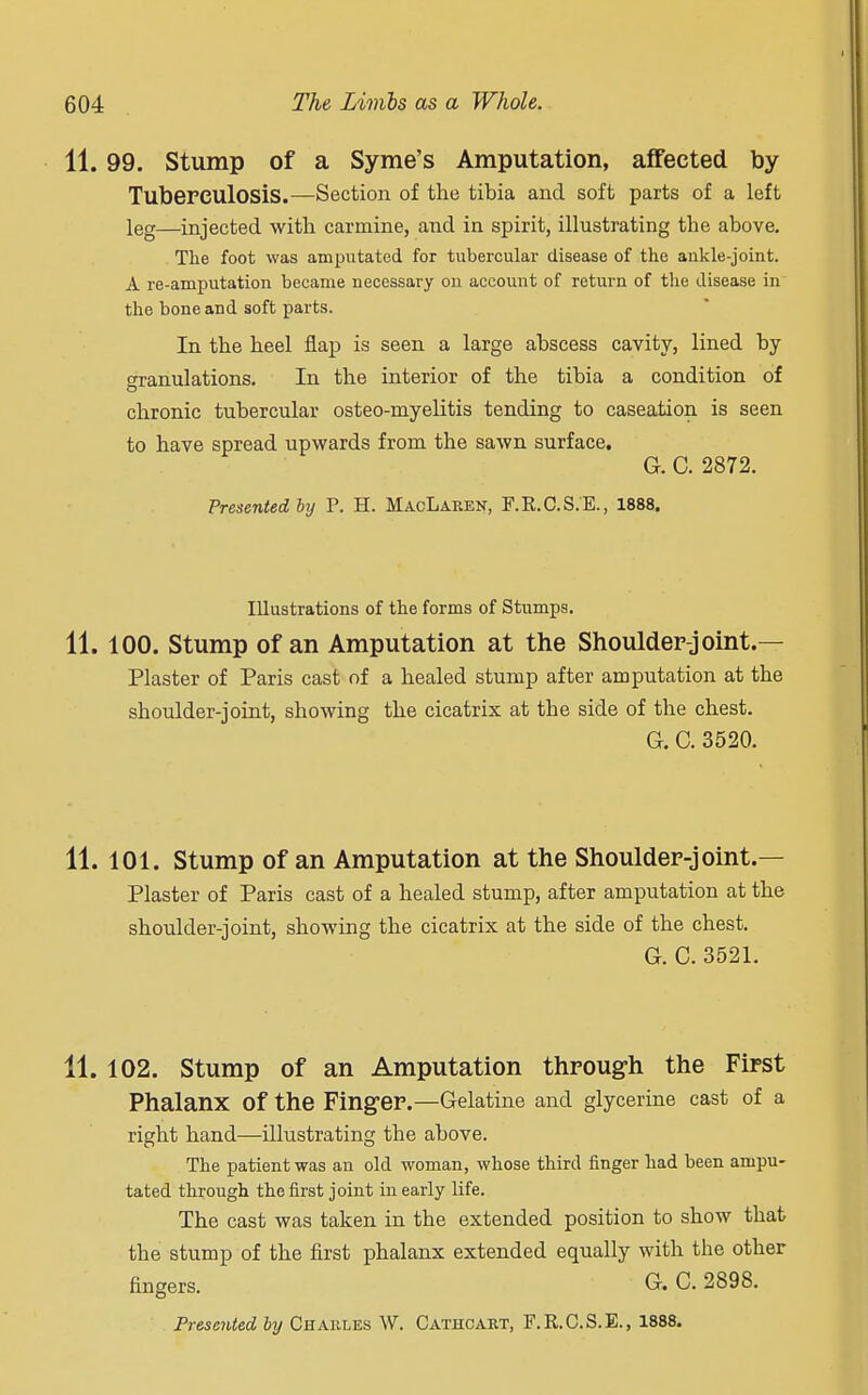 11.99. Stump of a Syme's Amputation, affected by Tuberculosis.—Section of the tibia and soft parts of a left leg—injected with carmine, and in spirit, illustrating the above. The foot was amputated for tubercular disease of the ankle-joint. A re-amputation became necessary on account of return of the disease in the bone and soft parts. In the heel flap is seen a large abscess cavity, lined by Granulations. In the interior of the tibia a condition of chronic tubercular osteo-myelitis tending to caseation is seen to have spread upwards from the sawn surface. G. C. 2872. Presented by P. H. MacLaren, F.R.C.S.E., 1888. Illustrations of the forms of Stumps. 11. 100. Stump of an Amputation at the Shoulder-joint.— Plaster of Paris cast of a healed stump after amputation at the shoulder-joint, showing the cicatrix at the side of the chest. G. C. 3520. 11. 101. Stump of an Amputation at the Shoulder-joint.— Plaster of Paris cast of a healed stump, after amputation at the shoulder-joint, showing the cicatrix at the side of the chest. G. C. 3521. 11. 102. Stump of an Amputation through the First Phalanx Of the Finger.—Gelatine and glycerine cast of a right hand—illustrating the above. The patient was an old woman, whose third finger had been ampu- tated through the first joint in early life. The cast was taken in the extended position to show that the stump of the first phalanx extended equally with the other fingers. G. C. 289S. Presented by Charles W. Cathcart, F.R.C.S.E., 1888.