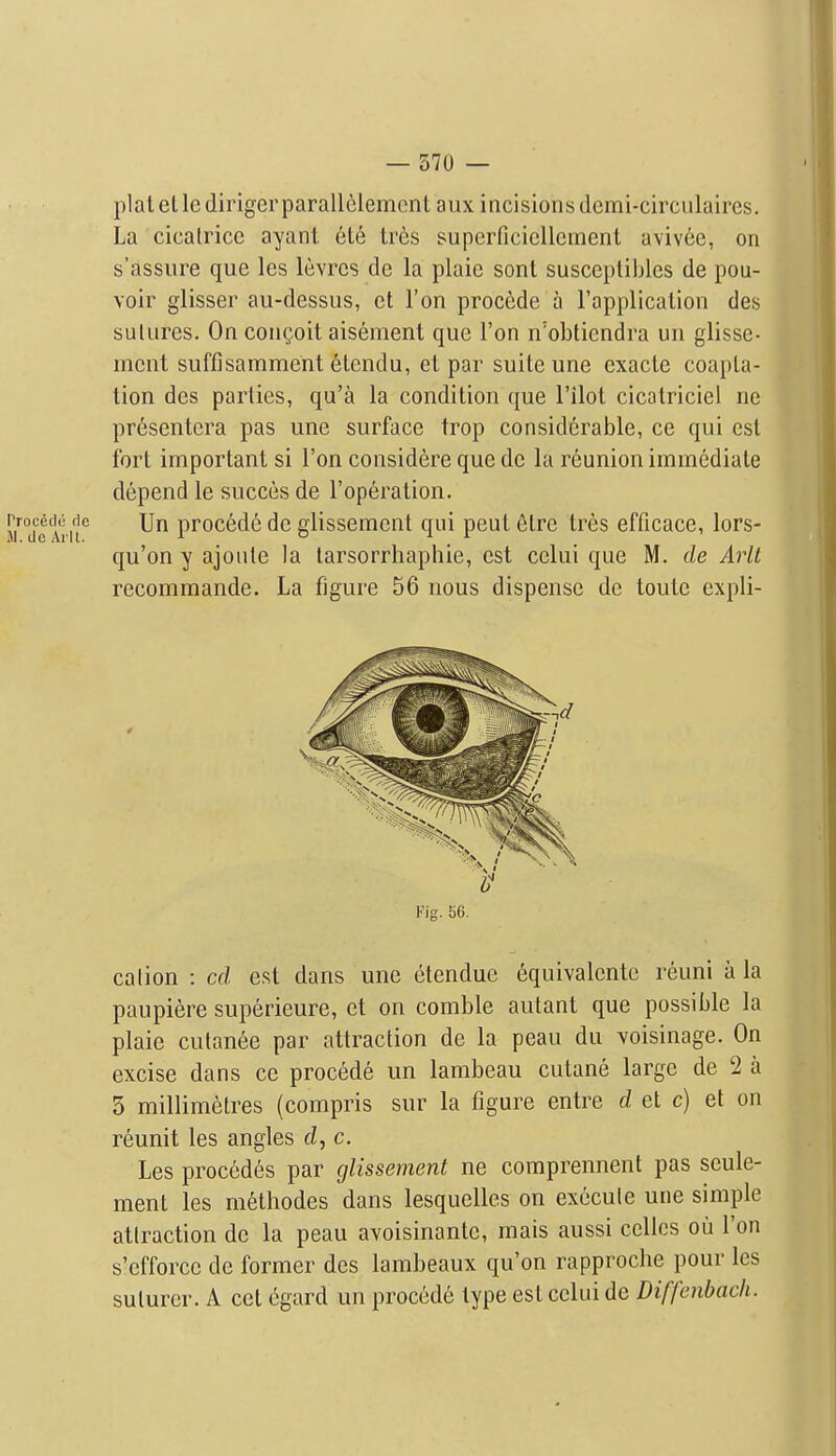 — 570 — plat el le diriger parallMement aux incisions dcmi-circiilaircs. La cicatrice ayant 6t6 tr6s superficiellement aviv6c, on s'assure que les levrcs de la plaie sont susceptibles de pou- voir glisser au-dessus, et Ton precede a I'applicalion des sutures. On congoit aisement que Ton n'obtiendra un glisse- ment suffisamment etendu, et par suite une exacte coapta- tion des parties, qu'a la condition que Pilot cicatriciel ne pr6sentera pas une surface trop considerable, ce qui est fort important si Ton considere que de la reunion immediate depend le succes de I'operation. procecN; fic jjn proc6d6 de glissement qui peul etre tres efficace, lors- qu'on y ajoiile la tarsorrhaphie, est celui que M. de Arlt recomraande. La figure 56 nous dispense de toute expli- cation : cd est dans une etendue 6quivalcnte reuni a la paupiere superieure, et on comble autant que possible la plaie cutanee par attraction de la peau du voisinage. On 3 millimetres (compris sur la figure entre d et c) et on reunit les angles rf, c. Les precedes par glissement ne comprennent pas seule- ment les methodes dans lesquelles on execute une simple attraction de la peau avoisinante, mais aussi celies ou Ton s'efforcc de former des lambeaux qu'on rapproche pour les suturer. A eel cgard un procede type est celui de Diffcnbach. Kig. 56.