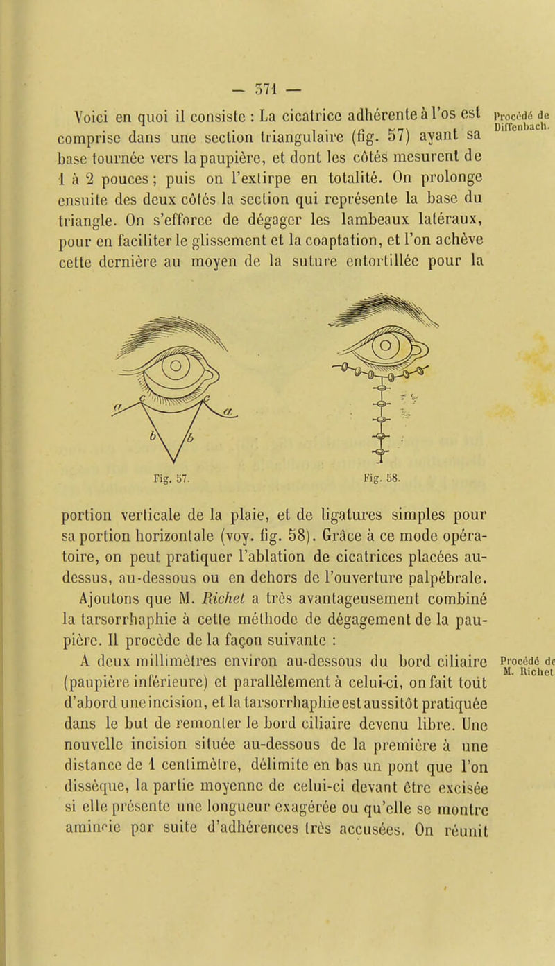 Voici en qiioi il consistc : La cicatrice adhcrentearos est Proc^dd de 1 • • 1 • /r- fix to Diffenbacli. comprise dans iinc section tnangulaire (tig. o/j ayani sa base tournte vers lapaupiere, et dont les cotes mesurenl de 1 a 2 pouces; puis on I'exlirpe en totalite. On prolongc ensuite des deux cotes la section qui represente la base du triangle. On s'efforcc de degagcr les lambeaux lateraux, pour en faciliter le glissement et la coaptation, et Ton acheve celte dcrniere au moyen de la sutuie cntortillee pour la Fig. 57. Fig. 58. portion verlicale de la plaie, et de ligatures simples pour sa portion horizontale (voy. fig. 58). Grace a ce mode op6ra- toire, on pent pratiquer I'ablation de cicatrices plac6es au- dessus, au-dessous ou en dehors de I'ouverture palp6brale. Ajoutons que M. Richet a tres avantageusement combine la tarsorrhaphie a cetle melhode de degagement de la pau- pierc. II precede de la fagon suivantc : A deux millimetres environ au-dessous du bord ciliaire ^^'^^^^ (paupicre inferieure) et parall61ement a celui-ci, on fait toiit d'abord unc incision, et la tarsorrhaphie est aussitot pratiquee dans le but de remonler le bord ciliaire devenu libre. Une nouvelle incision situee au-dessous de la premiere a une distance de 1 centimetre, delimite en bas un pont que Ton disseque, la partie moyenne de celui-ci devant 6trc excis6e si elle presentc une longueur exageree ou qu'elle se montrc aminric par suite d'adherences Ires accusees. On reunit