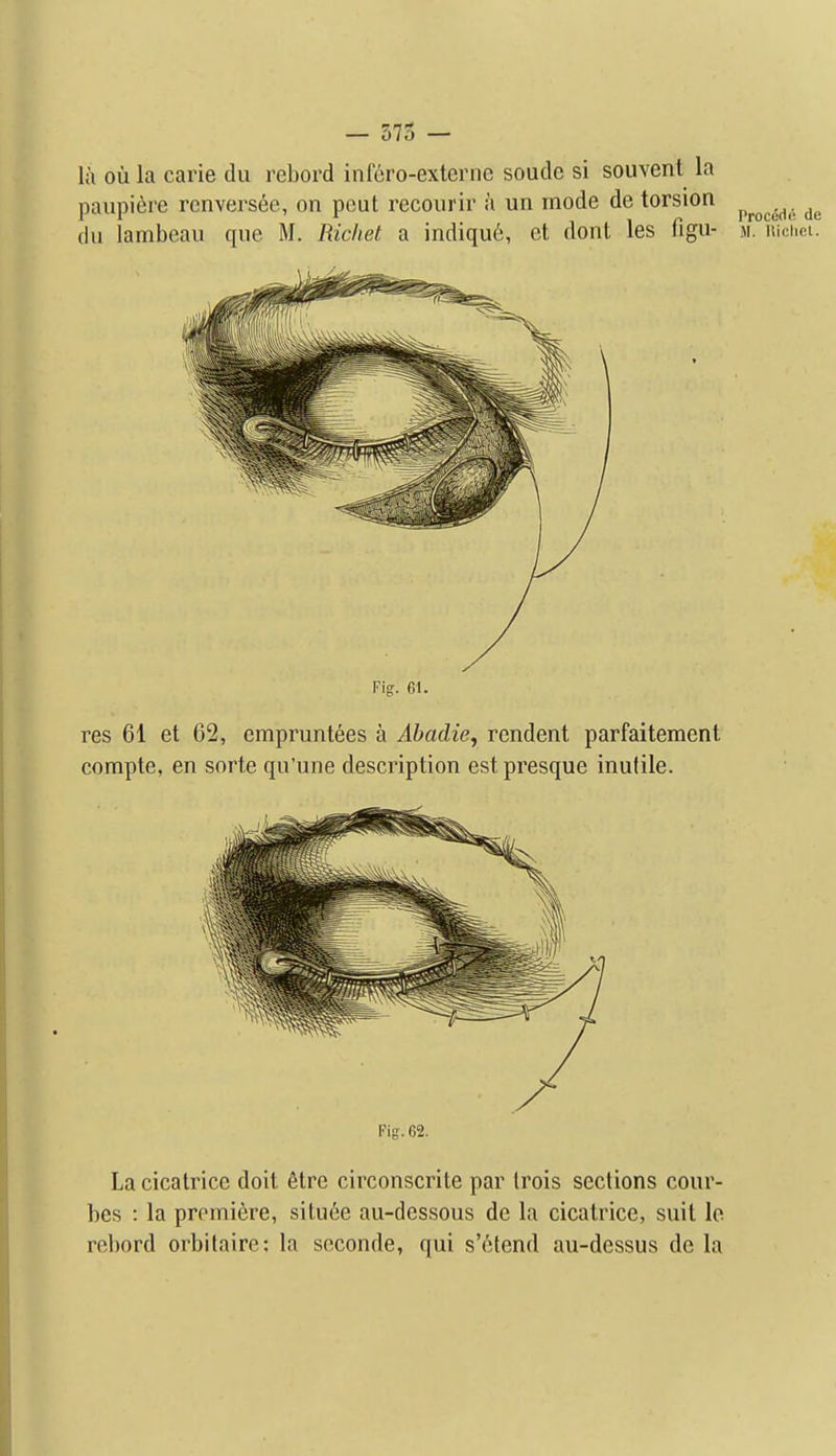 — 575 — la ou la carie du rebord infcro-externe soude si souvent la paupiere rcnvers^e, on peut recoiirir a un mode de torsion ^^^^^ du lambeau que M. Richet a indiqu6, ct dont les figu- m. uicuei. Fig. 61. res 61 et 62, cmpruntees a Abadie, rendent parfaitement compte, en sorte qu'une description estpresque inulile. Fig. 62. La cicatrice doit 6tre circonscrite par Irois sections cour- bes : la premiere, situee au-dessous de la cicatrice, suit le rebord orbilaire: la soconde, qui s'ctend au-dessus do la