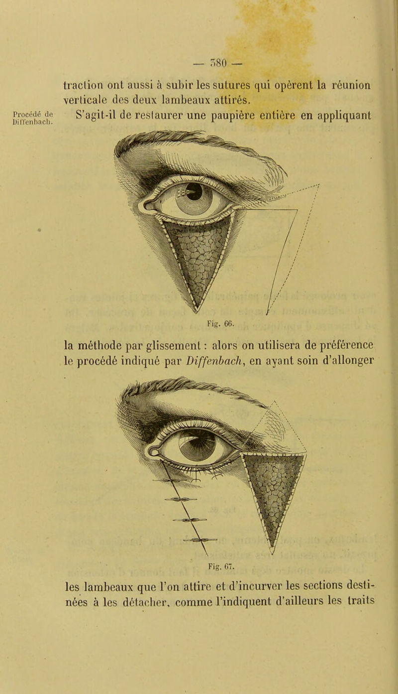 I'rocodd de DilTenhacli. Fig. 66. la methode par glissement: alors on utilisera de preference le proc6d6 indiqu6 par Diffenbach, en ayant soin d'allonger Fig. 67. les lambeaux que Ton altire et d'incurvcr les sections desli- nees a les detacher, comme I'indiquent d'ailleurs les traits