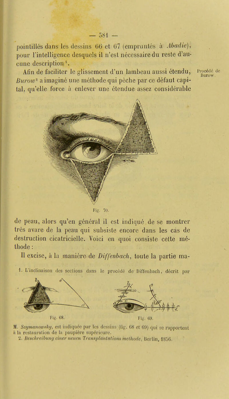 poinlilles dans les dessins 06 et 07 (empruiilos a Abadie)i pour rinlelligcnce desquels il n'esl necessairedu reste d'au- ciine description ^ Afin de faciliter le fflissement d'un lambeau aussi etendu, iwdc dc Burow' a imagine une methode qui pcche par cc defaul capi- tal, qu'ellc force a enlever une elendue assez considerable Fig. 70. de peau, alors qu'en general il est indique de se montrer ires avare de la peau qui subsiste encore dans les cas de destruction cicatricielle. Voici eti quoi consiste cette me- thode : 11 excise, a la manierc de Diffenbacli, loule la partie ma- 1. L'inclinaison des sections dans le precede de Diffenbacli, decrit par FiiJ. 68. Fin, 69. M. Szymanowsky, est indiquee par Ics dessins (fig. 68 et 69) qui se I'apporlenl a la restauralion de la paupiere siipiricure. 2. Besclircibung cincr neucn Ti ansiilanlalions mclhodc, Berlin, 1856.
