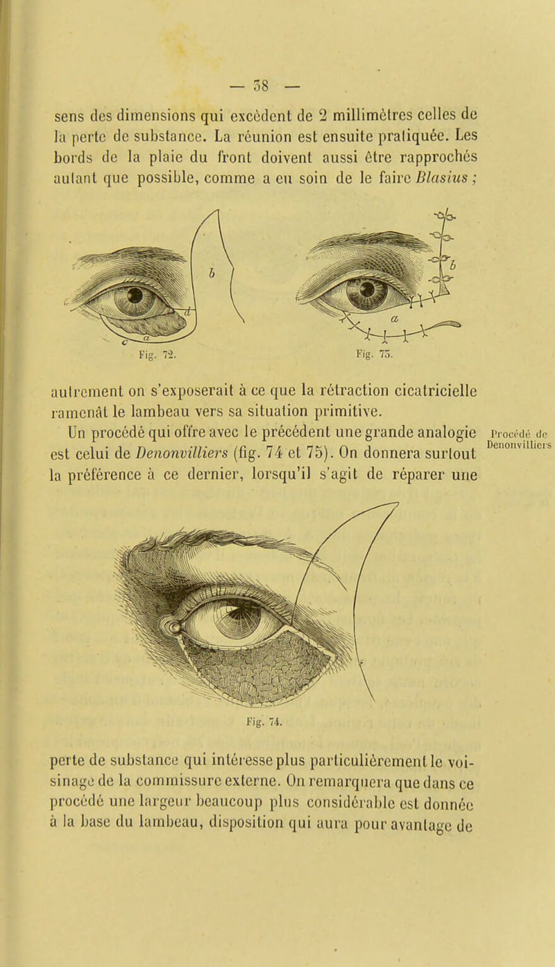 — 38 — sens des dimensions qui exccdcnt de 2 millimelres celles de la pertc de substance. La reunion est ensuite praliquee. Les bords de la plaie du front doivent aussi etre rapprochcs aulant que possible, comme a eu soin de le fairc Blasius; Fig. 7-2. Fig. 75. uulrcment on s'exposerait a ce que la retraction cicatricielle ramcnal le lambeau vers sa situation primitive. Un precede qui oft're avec le precedent une grande analogic viowtiy. do est celui de Denonvilliers (fig. 74 et 75). On donnera surlout la preference a ce dernier, lorsqu'il s'agit de reparer une Fig. 74. perle de substance qui inleresseplus parliculiercmentle voi- sinago de la commissure externe. On remarquera que dans ce proccde une largeur bcaucoup pins considerable est donnoe a la base du lambeau, disposition qui aura pour avanla^e de