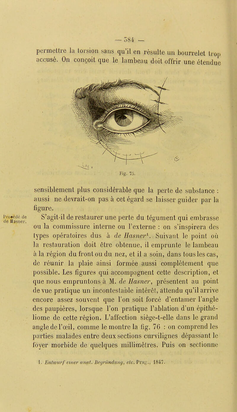 pcrmetlre la torsion saus qu'il en resulte un bourrelet li op accuse. On congoil que le lambeau doit oflrir une etendue Kig. 7o. sensiblement plus considerable que la perte de substance : aussi ne devrait-on pas a cet 6gard se laisser guider par la figure. S'agit-il de restaurer une perte du tegument qui embrasse ou la commissure interne ou I'externe : on s'inspirera des lypes operatoires dus a de HasnerK Suivant le point ou la restauration doit 6tre obtenue, il emprunte le lambeau a la region du front ou du nez, et il a soin, dans tousles cas, de reunir la plaie ainsi formee aussi completement que possible. Les figures qui accompagnent cette description, et que nous empruntons a M. de Hasner, presentent au point de vue pratique un incontestable interet, attendu qu'il arrive encore assez souveut que Ton soit force d'entamer Tangle des paupieres, lorsque Ton pratique I'ablation d'un epithe- liome de cette region. L'affection siege-t-elle dans le grand angle del'oeil, comme le montre la fig. 76 : on comprend les parties malades entre deux sections curvilignes d^passant Ic foyer morbide de quelques millimelres. Puis on seclionne I. Entwurf enter anat. Dcyriimhuuj, c/c. Pray ., 1847.