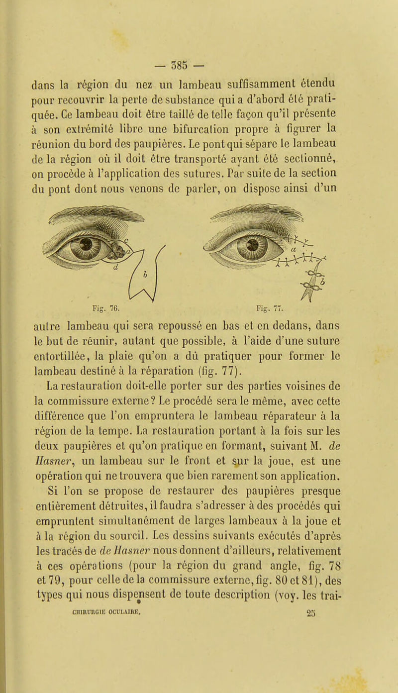 dans la region dii nez un lambeau suffisamment elendu pour rccouvrir la perte de substance qui a d'abord 6le prali- quee. Ce lambeau doit ^tre tailI6 de telle fagon qu'il pr6sente a son extremite libre une bifurcation propre a figurer la reunion du bord des paupieres. Le pontqui separc le lambeau de la region oil il doit 6tre transporte ayanl ete seclionne, on precede a I'applicalion des sutures. Par suite de la section du pont dont nous venons do parler, on dispose ainsi d'un Fig. 76. Fig. 77. autre lambeau qui sera repousse en bas et en dedans, dans le but de reunir, autant que possible, a I'aide d'une suture entortillee, la plaie qu'on a du pratiquer pour former le lambeau destine a la reparation (fig. 77). Larestauration doit-ellc porter sur des parties voisines de la commissure externe? Le procede sera le meme, avec celte difference que Ton empruntera le lambeau reparateur a la region de la tempe. La restauration portant a la fois sur les deux paupieres et qu'on pratique en formant, suivant M. de Hasner^ un lambeau sur le front et ^r la joue, est une operation qui ne trouvera que bien rarement son application. Si Ton se propose de restaurer des paupieres presque entierement detruites, il faudra s'adresser a des precedes qui empruntent simultanement de larges lambeaux a la joue et a la region du sourcil. Les dessins suivants executes d'apres les traces de de Hasner nous donnent d'ailleurs, relativement a ces operations (pour la region du grand angle, fig. 78 et79, pour celledela commissure externe,fig. 80et81), des types qui nous dispenscnt de toute description (voy. les trai- CIIIBURGIE OCULMBE, 25