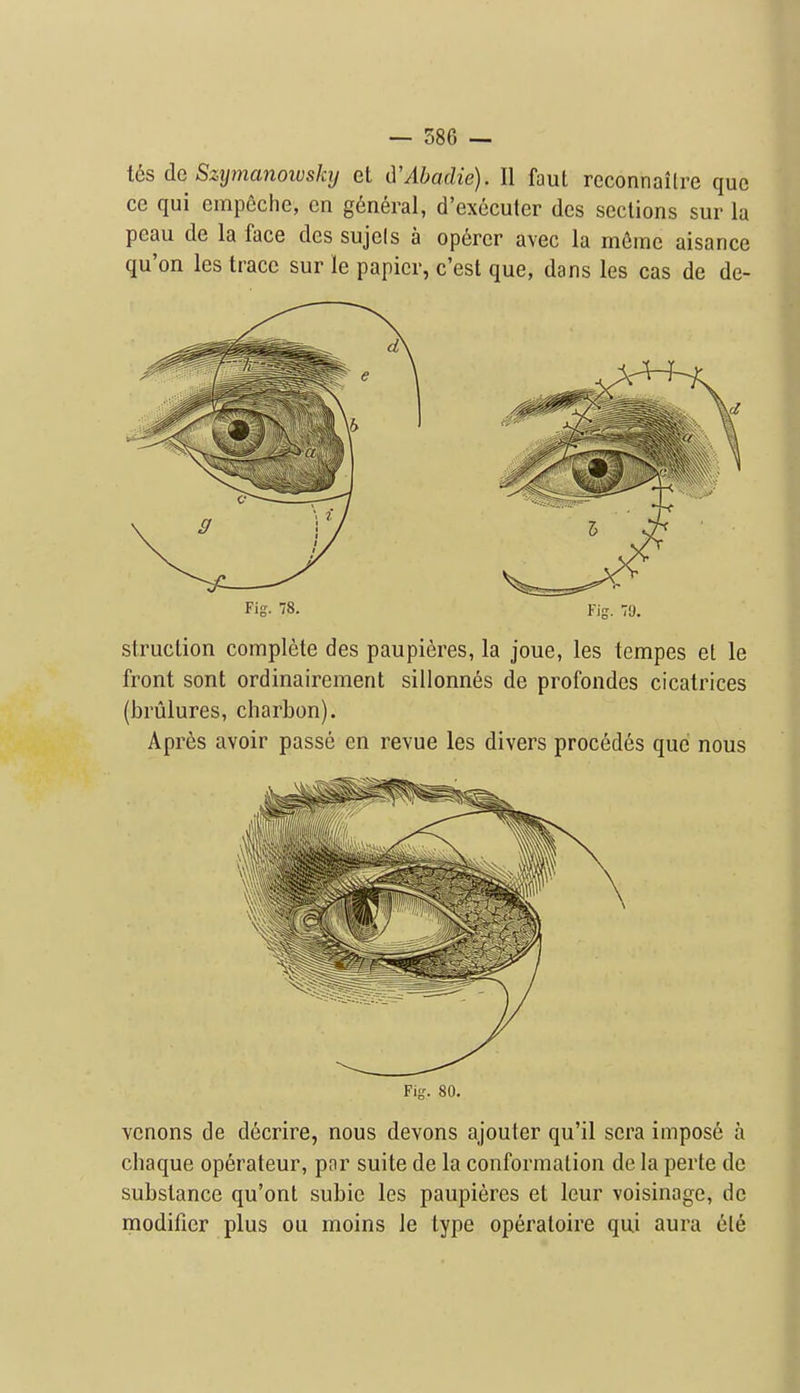 i6s dc Szijmanoivskij et d'Abaclie). II faut reconnailre que ce qui cmpoclie, cn general, d'excculer dcs sections sur la peau de la face dcs sujels a operer avec la mfime aisance qu'on les trace sur le papier, c'est que, dans les cas de de- rig- '78. Fig. 79. struction complete des paupieres, la joue, les tempes et le front sont ordinairement sillonnes de profondes cicatrices (brulures, charbon). Apres avoir passe en revue les divers procedes que nous Fig. 80. vcnons de d6crire, nous devons ajouter qu'il sera impost a cheque operateur, pnr suite de la conformation de la perte de substance qu'onl subie les paupieres et leur voisinage, de modifier plus ou moins le type operatoire qui aura ele