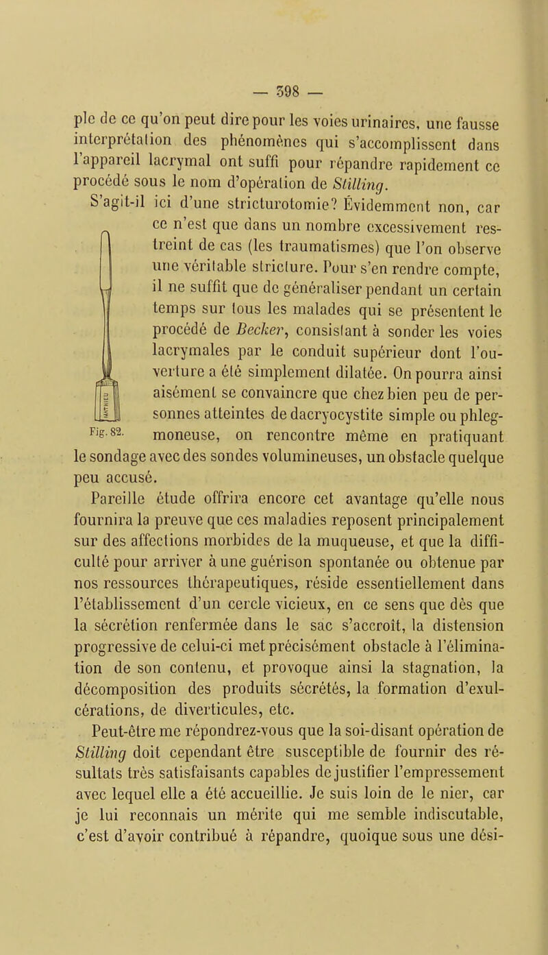 pic dc CO qu'on peut dire pour les voies urinaircs, urie fausse intcrpretalion des phenome.ncs qui s'accomplisscnt dans I'appareil lacrymal ont suffi pour rcpandre rapidement ce precede sous le nom d'operalion de Slilling. S'agit-il ici d'une stricturotomie? Evidemmcnt non, car ce n'est que dans un nombre cxcessivement res- Ireint de cas (les traumalismes) que Ton observe une veritable striclure. Pour s'en rendre compte, J il ne suffit que de generaliser pendant un certain temps sur lous les malades qui se presentent le precede de Becker, consislant a sender les voies lacrymales par le conduit superieur dont I'ou- verture a 6le simplemenl dilatee. Onpourra ainsi aisement se convaincre que chezbien peu de per- sonnes atteintes de dacryocystite simple ou phleg- moneuse, on rencontre meme en pratiquant le sondage avec des sondes volumineuses, un obstacle quelque peu accuse. Pareille ^tude offrira encore cet avantage qu'elle nous fournira la preuve que ces maladies reposent principalement sur des affections morbides de la muqueuse, et que la diffi- culte pour arriver a une guerison spontanee ou obtenue par nos ressources thcrapeutiques, reside essentiellement dans I'etablissement d'un cercle vicieux, en ce sens que des que la secretion renfermee dans le sac s'accroit, la distension progressive de celui-ci metprecisement obstacle a I'elimina- tion de son contenu, et provoque ainsi la stagnation, la decomposition des produits secretes, la formation d'exul- cerations, de diverticules, etc. Peut-etre me repondrez-vous que la soi-disant operation de Stilling doit cependant etre susceptible de fournir des r6- sultats tres satisfaisants capables de justifier I'empressement avec lequel elle a ete accueillie. Je suis loin de le nier, car je lui reconnais un merite qui me semble indiscutable, c'est d'avoir contribu6 a repandre, quoique sous une desi-
