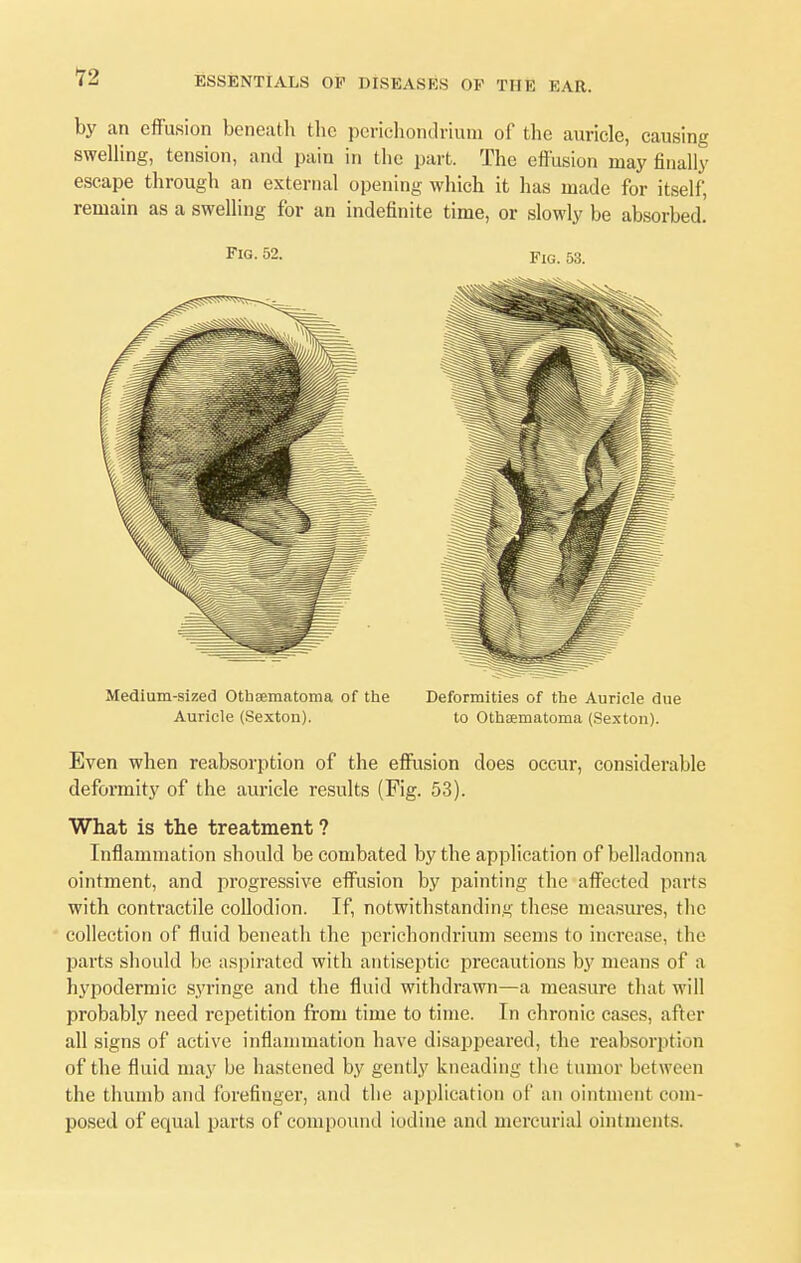 12 by an effusion beneath the perichondrium of the auricle, causing swelling, tension, and pain in the part. The effusion may finally escape through an external opening which it has made for itself, remain as a swelling for an indefinite time, or slowly be absorbed. Fl(5- 52. Fig. 53. Medium-sized Othsematoma of the Deformities of the Auricle due Auricle (Sexton). to Othaematoma (Sexton). Even when reabsorption of the effusion does occur, considerable deformity of the auricle results (Fig. 53). What is the treatment ? Inflammation should be combated by the application of belladonna ointment, and progressive effusion by painting the affected parts with contractile collodion. If, notwithstanding these measures, the collection of fluid beneath the perichondrium seems to increase, the parts should be aspirated with antiseptic precautions by means of a hypodermic syringe and the fluid withdrawn—a measure that will probably need repetition from time to time. In chronic cases, after all signs of active inflammation have disappeared, the reabsorption of the fluid may be hastened by gently kneading the tumor between the thumb and forefinger, and the application of an ointment com- posed of equal parts of compound iodine and mercurial ointments.