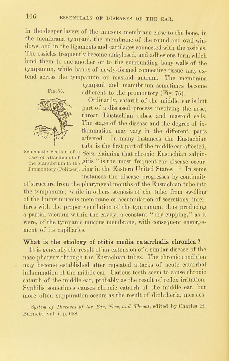 in the deeper layers of the mucous membrane close to the bone, in the membrana tympani, the membrane of the round and oval win- dows, and in the ligaments and cartilages connected with the ossicles. The ossicles frequently become ankylosed, and adhesions form which bind them to one another or to the surrounding bony walls of the tympanum, while bands of newly-formed connective tissue may ex- tend across the tympanum or mastoid antrum. The membrana tympani and manubrium sometimes become Pig. 76. adherent to the promontory (Fig. 76). Ordinarily, catarrh of the middle ear is but part of a diseased process involving the nose, throat, Eustachian tubes, and mastoid cells. The stage of the disease and the degree of in- flammation may vary in the different parts affected. In many instances the Eustachian tube is the first part of the middle ear affected, Schematic Section of n Seij,s ciaiming that cnronjc Eustachian salpin- Case of Attachment oi . . .. . , _ 1 the Manubrium to the §ltls 18 tne most frequent ear disease occur- Promontory (Poiitzer). ring in the Eastern United States. 1 In some instances the disease progresses by continuity of structure from the pharyngeal mouths of the Eustachian tube into the tympanum ; while in others stenosis of the tube, from swelling of the lining mucous membrane or accumulation of secretions, inter- feres with the proper ventilation of the tympanum, thus producing a partial vacuum within the cavity, a constant dry-cupping, as it were, of the tympanic mucous membrane, with consequent engorge- ment of its capillaries. What is the etiology of otitis media catarrhalis chronica? It is generally the result of an extension of a similar disease of the naso-pharynx through the Eustachian tubes. The chronic condition may become established after repeated attacks of acute catarrhal inflammation of the middle ear. Carious teeth seem to cause chronic catarrh of the middle ear, probably as the result of reflex irritation. Syphilis sometimes causes chronic catarrh of the middle ear, but more often suppuration occurs as the result of diphtheria, measles, 1 System of Diseases of the Ear, Nose, and Throat, edited by Charles H. Burnett, vol. i. ]>. 658.