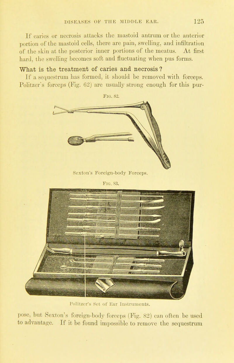 [f caries or necrosis attacks the mastoid antrum or the anterior portion of the mastoid cells, there are pain, swelling, and infiltration of the skin at the posterior inner portions of the meatus. At first hard, the swelling becomes soft and fluctuating when pus forms. What is the treatment of caries and necrosis ? If a sequestrum has formed, it should be removed with forceps. Politzer's forceps (Fig. 62) are usually strong enough for this pur- Fio. 82. Sexton's Foreign-body Forceps. Fin. S3. Politzer's Set of Eur Instruments. pose, but Sexton's foreign-body forceps (Fig. 82) can often be used to advantage. If it be found impossible to remove the sequestrum