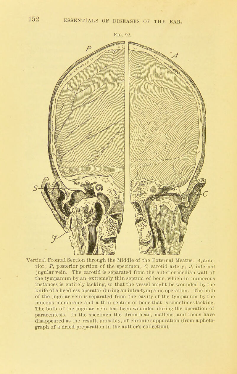 Fig. 92. Vertical Frontal Section through the Middle of the External Meatus: ^.ante- rior; P, posterior portion of the specimen; C, carotid artery; J, internal jugular vein. The carotid is separated from the anterior median wall of the tympanum by an extremely thin septum of bone, which in numerous instances is entirely lacking, so that the vessel might be wounded by the knife of a heedless operator during an intra-tympanic operation. The bulb of the jugular vein is separated from the cavity of the tympanum by the mucous membrane and a thin septum of bone that is sometimes lacking. The bulb of the jugular vein has been wounded during the operation of paracentesis. In the specimen the drum-head, malleus, and incus have disappeared as the result, probably, of chronic suppuration (from a photo- graph of a dried preparation in the author's collection),