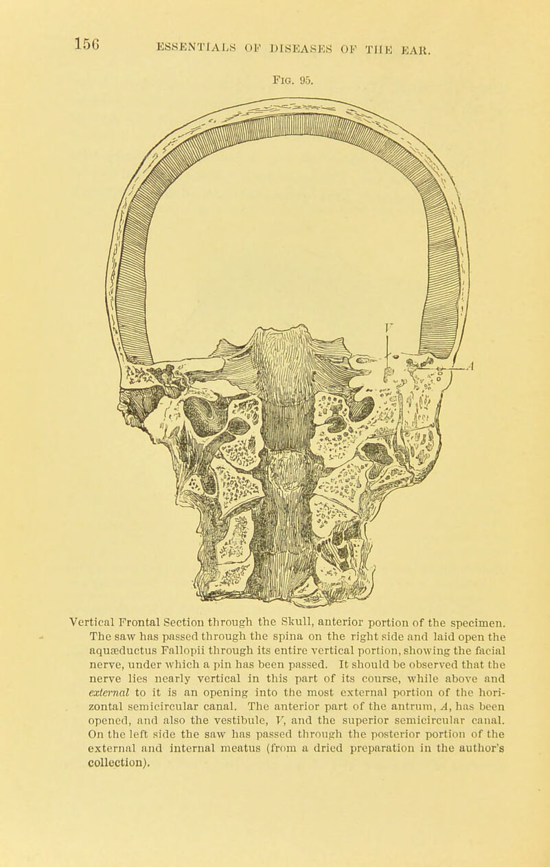 Fig. 95. Vertical Frontal Section through the Skull, anterior portion of the specimen. The saw has passed through the spina on the right side and laid open the aquseductus Fallopii through its entire vertical portion, showing the facial nerve, under which a pin has been passed. It should be observed that the nerve lies nearly vertical in this part of its course, while above and external to it is an opening into the most external portion of the hori- zontal semicircular canal. The anterior part of the antrum, A, has been opened, and also the vestibule, 1', and the superior semicircular canal. On the left side the saw has passed through the posterior portion of the external and internal meatus (from a dried preparation in the author's collection).