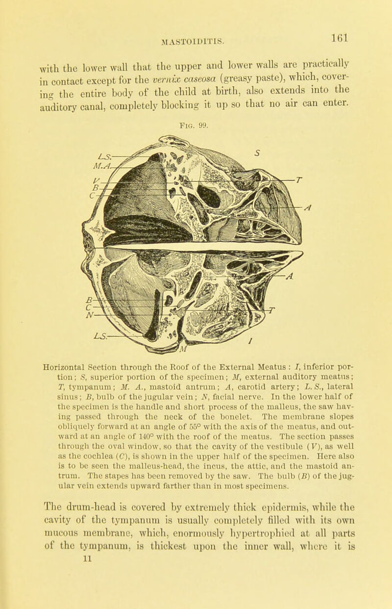 1(51 with the lower wall that the upper and lower walls are practically in contact except for the vernix caseosa (greasy paste), which, cover- ing the entire body of the child at birth, also extends into the auditory canal, completely blocking it up so that no air can enter. Fig. 99. Horizontal Section through the Roof of the External Meatus : 7, inferior por- tion ; S, superior portion of the specimen; M, external auditory meatus; T, tympanum; M. A., mastoid antrum; A, carotid artery; L.S., lateral sinus; B, bulb of the jugular vein; JV, facial nerve. In the lower half of the specimen is the handle and short process of the malleus, the saw hav- ing passed through the neck of the bonelet. The membrane slopes obliquely forward at an angle of 55° with the axis of the meatus, and out- ward at an angle of 140° with the roof of the meatus. The section passes through the oval window, so that the cavity of the vestibule (V), as well as the cochlea (C), is shown in the upper half of the specimen. Here also is to be seen the malleus-head, the incus, the attic, and the mastoid an- trum. The stapes has been removed by the saw. The bulb (B) of the jug- ular vein extends upward farther than in most specimens. The drum-head is covered by extremely thick epidermis, while the cavity of the tympanum is usually completely filled with its own mucous membrane, which, enormously hypertrophied at all parts of the tympanum, is thickest upon the inner wall, where it is 11