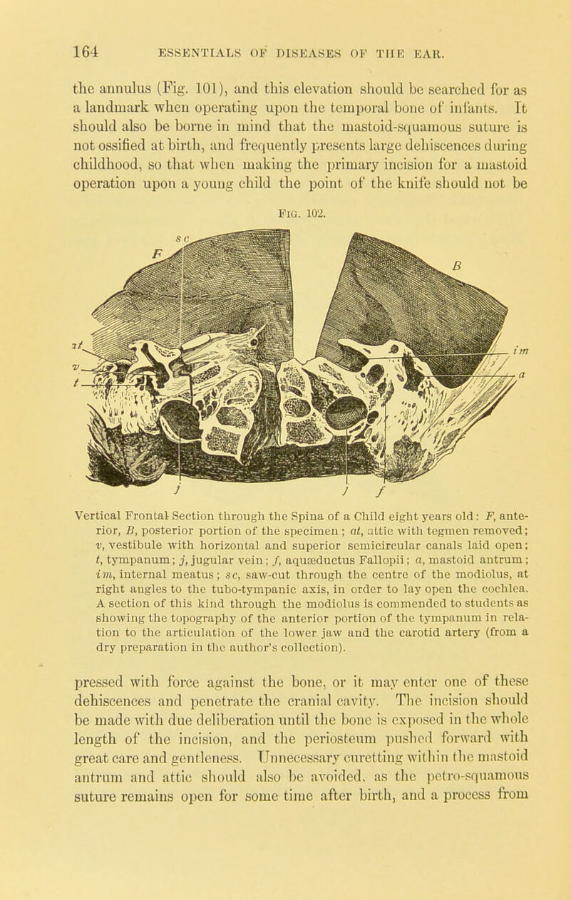 the annulus (Fig. 101), and this elevation should be searched for as a landmark when operating upon the temporal bone of infants. It should also be borne in mind that the mastoid-squamous suture is not ossified at birth, and frequently presents large dehiscences during childhood, so that when making the primary incision for a mastoid operation upon a young child the point of the knife should not be Fig. 102. Vertical Frontal Section through the Spina of a Child eight years old: F, ante- rior, B, posterior portion of the specimen ; at, attic with tegmen removed; v, vestibule with horizontal and superior semicircular canals laid open; t, tympanum; j, jugular vein; /, aquaeductus Fallopii; o, mastoid antrum; im, internal meatus; sc, saw-cut through the centre of the modiolus, at right angles to the tubo-tympanic axis, in order to lay open the cochlea. A section of this kind through the modiolus is commended to students as showing the topography of the anterior portion of the tympanum in rela- tion to the articulation of the lower jaw and the carotid artery (from a dry preparation in the author's collection). pressed with force against the bone, or it may enter one of these dehiscences and penetrate the cranial cavity. The incision should be made with due deliberation until the bone is exposed in the whole length of the incision, and the periosteum pushed forward with great care and gentleness. Unnecessary curetting within the mastoid antrum and attic should also be avoided, as the petro squamous suture remains open for some time after birth, and a process from