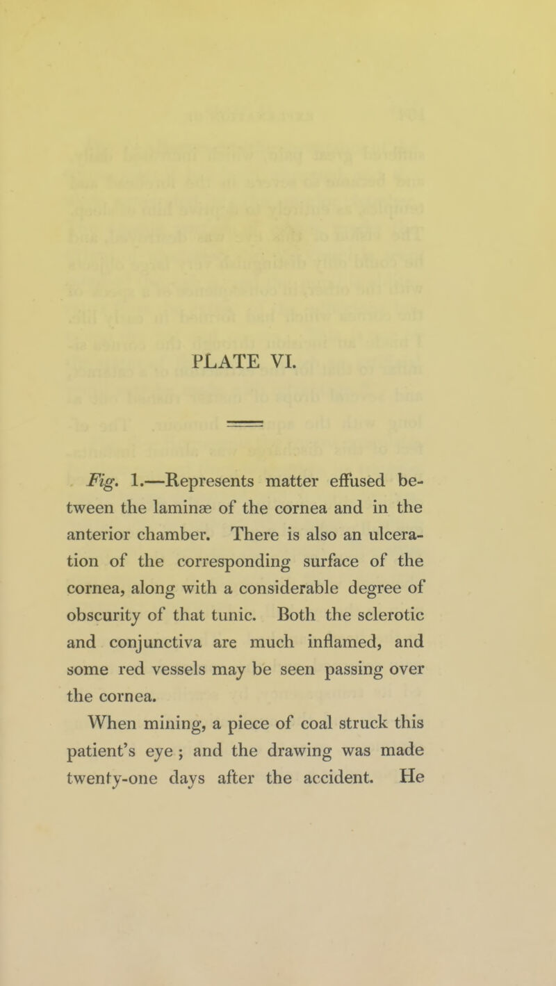 . Fig, 1.—Represents matter effused be¬ tween the laminae of the cornea and in the anterior chamber. There is also an ulcera¬ tion of the corresponding surface of the cornea, along with a considerable degree of obscurity of that tunic. Both the sclerotic and conjunctiva are much inflamed, and some red vessels may be seen passing over the cornea. When mining, a piece of coal struck this patient’s eye ; and the drawing was made twenfy-one days after the accident. He