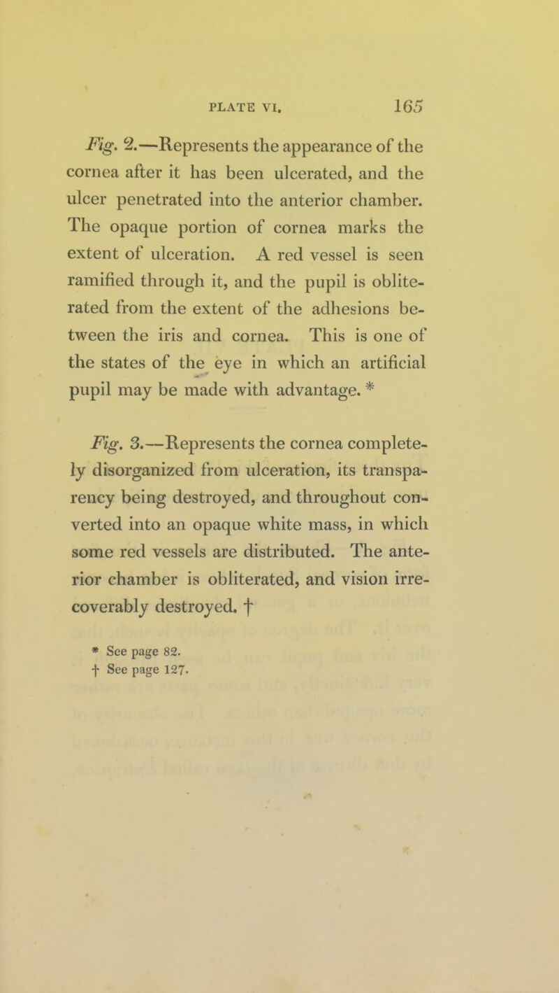 Fig. %—Represents the appearance of the cornea after it has been ulcerated, and the ulcer penetrated into the anterior chamber. The opaque portion of cornea marks the extent of ulceration. A red vessel is seen ramified through it, and the pupil is oblite¬ rated from the extent of the adhesions be¬ tween the iris and cornea. This is one of the states of the eye in which an artificial pupil may be made with advantage. * Fig. 3.—Represents the cornea complete¬ ly disorganized from ulceration, its transpa¬ rency being destroyed, and throughout con¬ verted into an opaque white mass, in which some red vessels are distributed. The ante¬ rior chamber is obliterated, and vision irre¬ coverably destroyed, f * See page 82. f See page 127*