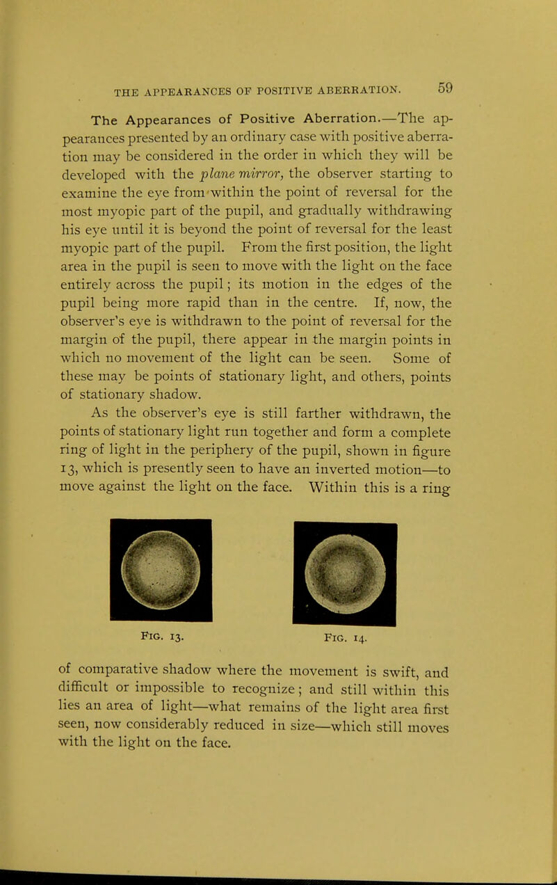 The Appearances of Positive Aberration.—The ap- pearances presented by an ordinary case with positive aberra- tion may be considered in the order in which they will be developed with the plane mirror, the observer starting to examine the eye from within the point of reversal for the most myopic part of the pupil, and gradually withdrawing his eye until it is beyond the point of reversal for the least myopic part of the pupil. From the first position, the light area in the pupil is seen to move with the light on the face entirely across the pupil; its motion in the edges of the pupil being more rapid than in the centre. If, now, the observer's eye is withdrawn to the point of reversal for the margin of the pupil, there appear in the margin points in which no movement of the light can be seen. Some of these may be points of stationary light, and others, points of stationary shadow. As the observer's eye is still farther withdrawn, the points of stationary light run together and form a complete ring of light in the periphery of the pupil, shown in figure 13, which is presently seen to have an inverted motion—to move against the light on the face. Within this is a ring Fig. 13. fig. 14. of comparative shadow where the movement is swift, and difficult or impossible to recognize; and still within this lies an area of light—what remains of the light area first seen, now considerably reduced in size—which still moves with the light on the face.