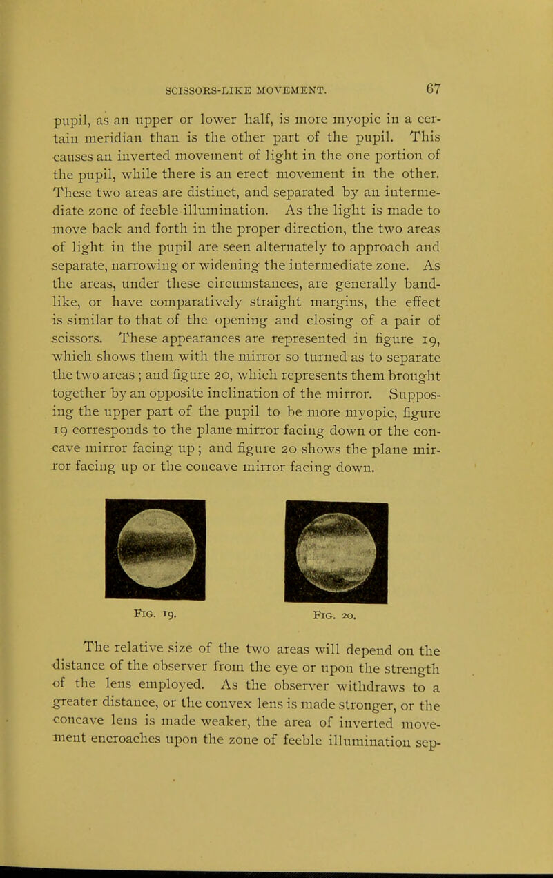 pupil, as an upper or lower half, is more myopic in a cer- tain meridian than is the other part of the pupil. This causes an inverted movement of light in the one portion of the pupil, while there is an erect movement in the other. These two areas are distinct, and separated by an interme- diate zone of feeble illumination. As the light is made to move back and forth in the proper direction, the two areas of light in the pupil are seen alternately to approach and separate, narrowing or widening the intermediate zone. As the areas, under these circumstances, are generally band- like, or have comparatively straight margins, the effect is similar to that of the opening and closing of a pair of scissors. These appearances are represented in figure 19, which shows them with the mirror so turned as to separate the two areas ; and figure 20, which represents them brought together by an opposite inclination of the mirror. Suppos- ing the upper part of the pupil to be more myopic, figure 19 corresponds to the plane mirror facing down or the con- cave mirror facing up; and figure 20 shows the plane mir- ror facing up or the concave mirror facing down. Fig. 19. Fig. 20. The relative size of the two areas will depend on the ■distance of the observer from the eye or upon the strength of the lens employed. As the observer withdraws to a greater distance, or the convex lens is made stronger, or the concave lens is made weaker, the area of inverted move- ment encroaches upon the zone of feeble illumination sep-