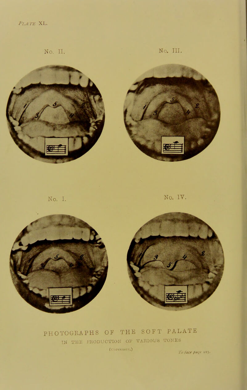 Plate XL. No. II. No. III. PHOTOGRAPHS OF THE SOFT PALATE IN THE PRODUCTION OK VARIOUS TONES (Coptkigu r.) lo face />.*v« :,5-