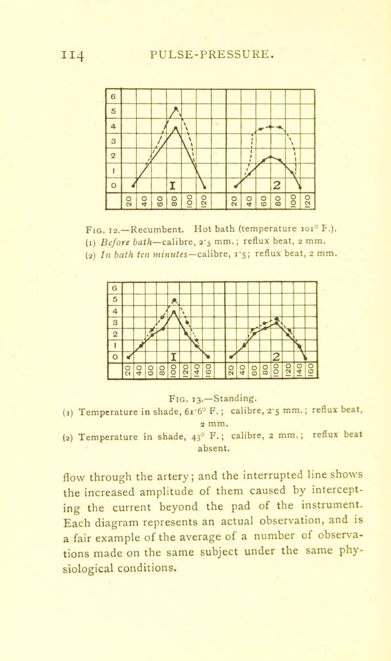 6 5 A 4 L % 3 0 , \ \ \ t 2 \l Y —%- 1 I 1 —1~ 0 I 2 O IN O o (0 o CO 001 o Cj o C4 o <* o CO o CO o o o Fig. 12.—Recumbent. Hot bath (temperature ioi= F.). (1) Before 6at/i—calibre, 2-5 mm.; reflux beat, 2 mm. (2) In bath ten Hiumifs—calibre, 1-5; reflux beat, 2 mm. 6 5 4 3 2 y r J / N 0 I 0 0 0 CD g 0 0 0 0 0 (0 0 IN 0 0 CO 0 a 0 0 0 c< 0 2 IGO Fig. 13.—Standing. (1) Temperature in shade, 6i-6° F.; calibre, 2-5 mm.; reflui beat, 2 mm. (2) Temperature in shade, 43° F.; calibre, 2 mm.; reflux beat absent. flow through the artery; and the interrupted line shows the increased amplitude of them caused by intercept- ing the current beyond the pad of the instrument. Each diagram represents an actual observation, and is a fair example of the average of a number of obser\'a- tions made on the same subject under the same phy- siological conditions.