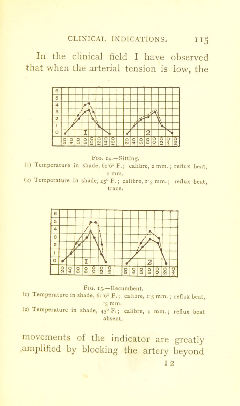 In the clinical field I have observed that when the arterial tension is low, the Fig. 14.—Sitting, (I) Temperature in shade, 6r6° F.; calibre, 2 mm.; reflux beat, I mm. (^) Temperature in shade, 43° F.; calibre, 1-5 mm.; reflux beat, trace. 6 5 ■A 4 b 3 I 2 1 / —. 1 0 ✓ ✓ W 0 (0 0 00 00 0 0 M s 0 CO CO 001 0 a Fig. 15.—Recumbent. (1) Temperature in shade, 6v6° F.; calibre, 1-5 mm.; reflux beat, ■5 mm. (2) Temperature in shade, 43° F.; calibre, i mm. | reflux beat absent. movements of the indicator are greatly .amplified by blocking the artery beyond I 2