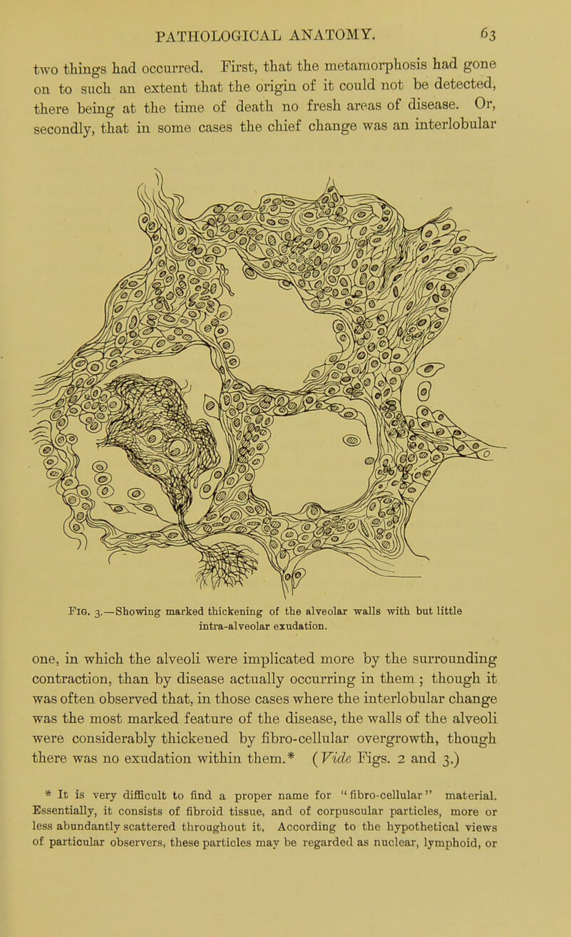 two things had occurred. First, that the metamorphosis had gone on to such an extent that the origin of it could not be detected, there being at the time of death no fresh areas of disease. Or, secondly, that in some cases the chief change was an interlobular Fig. 3.—Showing marked thickening of the alveolar walls with but little intra-alveolar exudation. one, in which the alveoli were implicated more by the surrounding contraction, than by disease actually occurring in them ; though it was often observed that, in those cases where the interlobular change was the most marked feature of the disease, the walls of the alveoli were considerably thickened by fibro-cellular overgrowth, though there was no exudation within them.* (Vide Figs. 2 and 3.) * It is very difficult to find a proper name for fibro-cellular material. Essentially, it consists of fibroid tissue, and of corpuscular particles, more or less abundantly scattered throughout it, According to the hypothetical views of particular observers, these particles may be regarded as nuclear, lymphoid, or