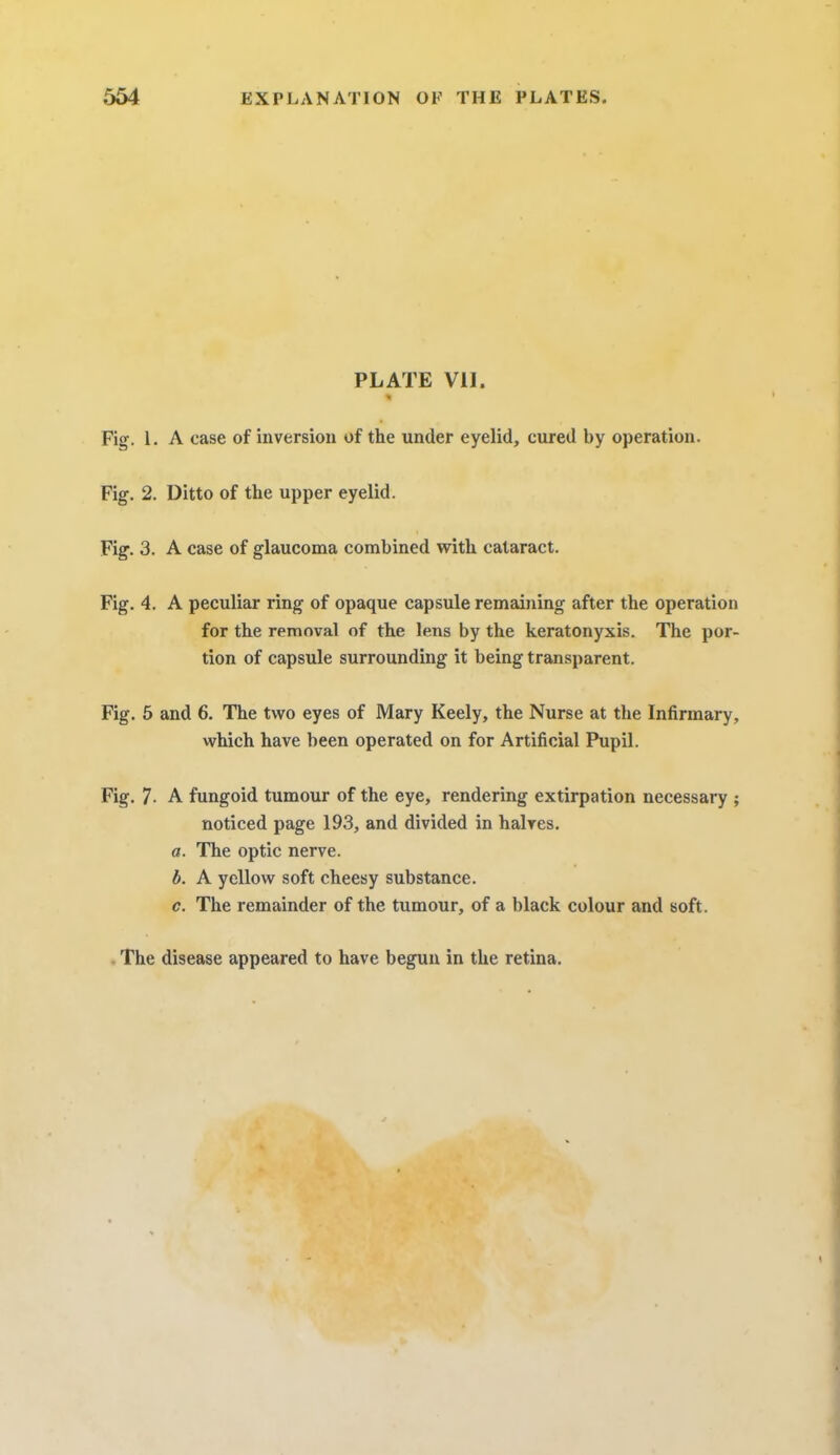 PLATE Vll. I Fig. 1. A case of inversion of the under eyelid, cured by operation. Fig. 2. Ditto of the upper eyelid. Fig. 3. A case of glaucoma combined with cataract. Fig. 4. A peculiar ring of opaque capsule remaining after the operation for the removal of the lens by the keratonyxis. The por- tion of capsule surrounding it being transparent. Fig. 5 and 6. The two eyes of Mary Keely, the Nurse at the Infirmary, which have been operated on for Artificial Pupil. Fig. 7- A fungoid tumour of the eye, rendering extirpation necessary ; noticed page 193, and divided in halves. a. The optic nerve. b. A yellow soft cheesy substance. c. The remainder of the tumour, of a black colour and soft. The disease appeared to have begun in the retina.