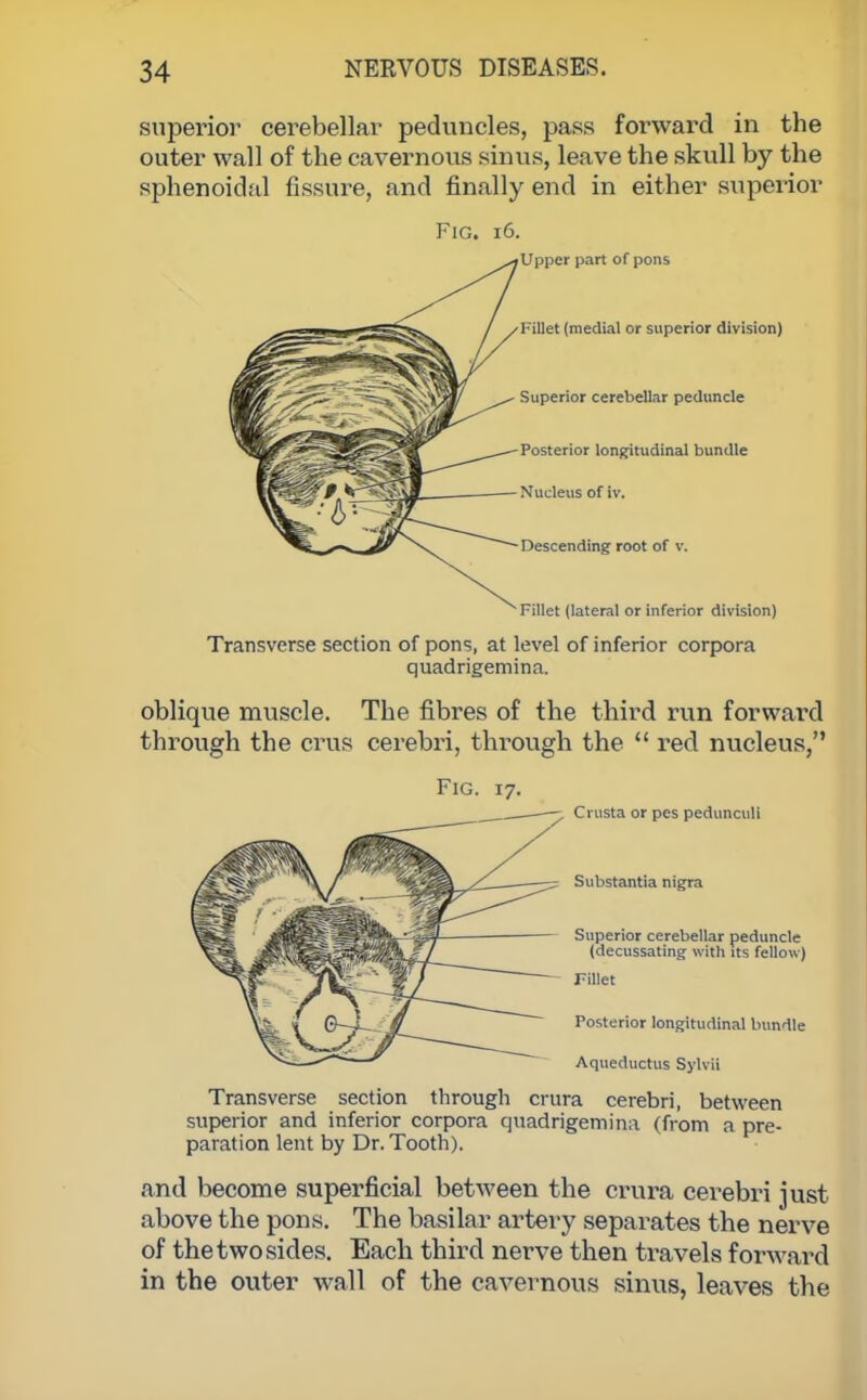 superior cerebellar peduncles, pass forwai'd in the outer wall of the cavernous sinus, leave the skull by the sphenoidal fissure, and finally end in either superior Fig. 16. Upper part of pons Fillet (medial or superior division) Superior cerebellar peduncle Posterior longitudinal bundle Nucleus of to. Descending root of v. Fillet (lateral or inferior division) Transverse section of pons, at level of inferior corpora quadrigemina. oblique muscle. The fibres of the third run forward through the crus cerebri, through the  red nucleus, Fig. 17. Crusta or pes pedunculi Substantia nigra Superior cerebellar peduncle (decussating with its fellow ) Fillet Posterior longitudinal bundle Aqueductus Sylvii Transverse section through crura cerebri, between superior and inferior corpora quadrigemina (from a pre- paration lent by Dr. Tooth). and become superficial between the crura cerebri just above the pons. The basilar artery separates the nerve of the two sides. Each third nerve then travels forward in the outer Avail of the cavernous sinus, leaves the