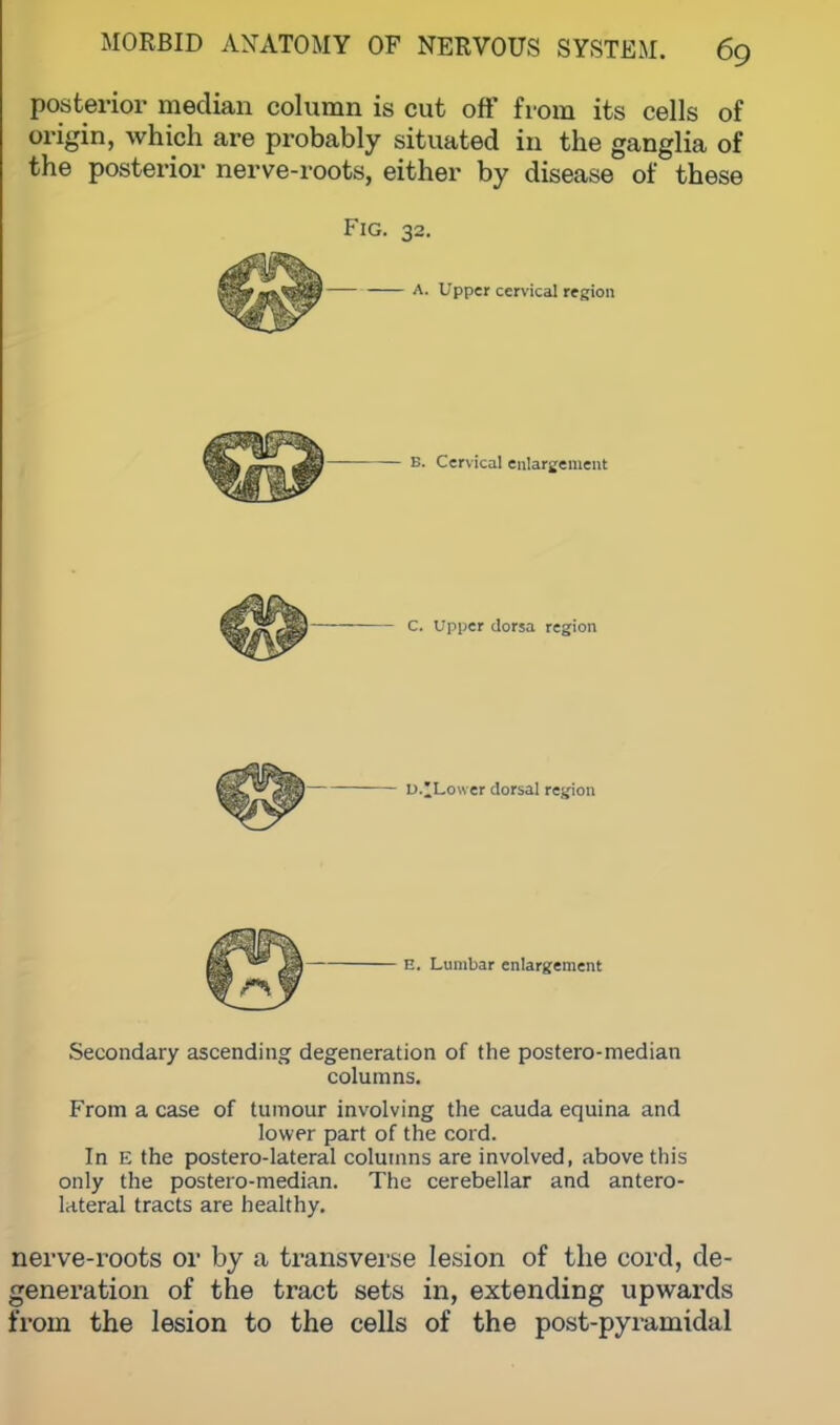 posterior median column is cut off from its cells of origin, which are probably situated in the ganglia of the posterior nerve-roots, either by disease of these Fig. 32. A. Upper cervical region B. Cervical enlargement c. Upper dorsa region D.^Loiver dorsal region E. Lumbar enlargement Secondary ascending degeneration of the postero-median columns. From a case of tumour involving the cauda equina and lower part of the cord. In E the postero-lateral columns are involved, above this only the postero-median. The cerebellar and antero- lateral tracts are healthy. nerve-roots or by a transverse lesion of the cord, de- generation of the tract sets in, extending upwards from the lesion to the cells of the post-pyramidal