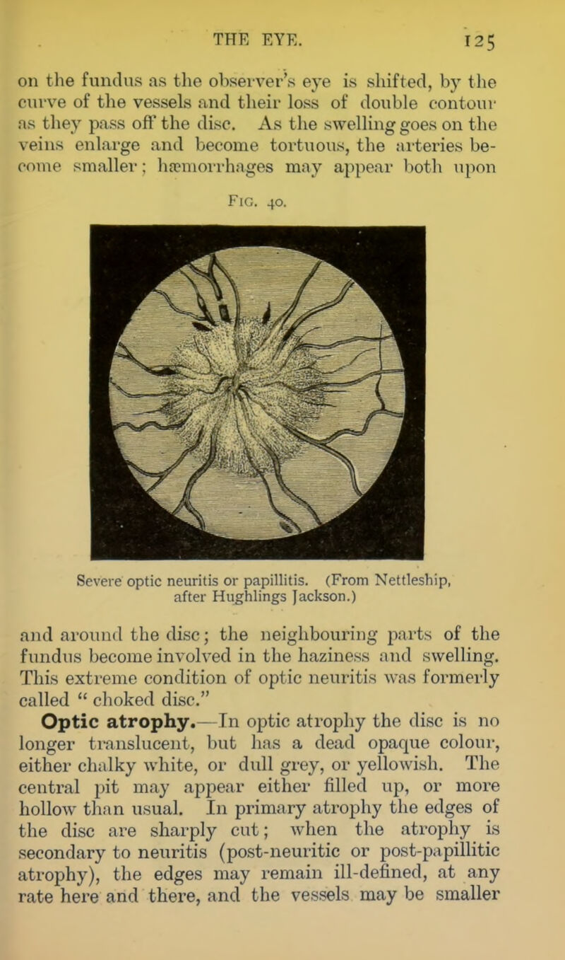 on the fundus as the observer's eye is shifted, by the curve of the vessels and their loss of double contour ns they pass off the disc. As the swelling goes on the veins enlarge and become tortuous, the arteries be- come smaller; haemorrhages may appear both upon Fig. 40. Severe optic neuritis or papillitis. (From Nettleship, after Hughlings Jackson.) and around the disc; the neighbouring parts of the fundus become involved in the haziness and swelling. This extreme condition of optic neuritis was formerly called  choked disc. Optic atrophy.— In optic atrophy the disc is no longer translucent, but has a dead opaque colour, either chalky white, or dull grey, or yellowish. The central pit may appear either filled up, or more hollow than usual. In primary atrophy the edges of the disc are sharply cut; when the atrophy is secondary to neuritis (post-neuritic or post-pa pillitic atrophy), the edges may remain ill-defined, at any rate here and there, and the vessels may be smaller