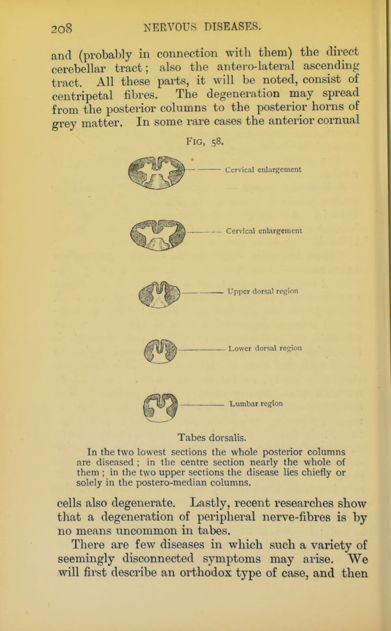 and (probably in connection with them) the direct cerebellar tract; also the anterolateral ascending tract. All these parts, it will be noted, consist of centripetal fibres. The degeneration may spread from the posterior columns to the posterior horns of grey matter. In some rare cases the anterior cornual Fig, 58. Cervical enlargement Cenical enlargement Upper dorsal region Lower dorsal region Lumbar region Tabes dorsalis. In the two lowest sections the whole posterior columns are diseased ; in the centre section nearly the whole of them ; in the two upper sections the disease lies chiefly or solely in the postero-median columns. cells also degenerate. Lastly, recent researches show that a degeneration of peripheral nerve-fibres is by no means uncommon in tabes. There are few diseases in which such a variety of seemingly disconnected symptoms may arise. We will first describe an orthodox type of case, and then