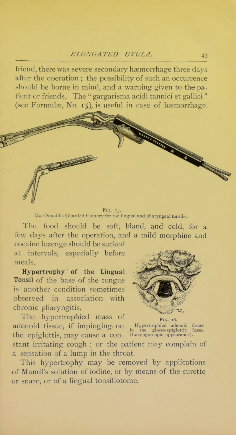 friend, there was severe secondary haemorrhage three days after the operation ; the possibility of such an occurrence should be borne in mind, and a warning given to the pa- tient or friends. The  gargarisma acidi tannici et gallici  (see Formulae, No. 15), is useful in case of haemorrhage. Fir.. 75. MacDonald's Guarded Cautery for the lingual and pharyngeal tonsils. The food should be soft, bland, and cold, for a few days after the operation, and a mild morphine and cocaine lozenge should be sucked at intervals, especially before meals. Hypertrophy of the Lingual Tonsil of the base of the tongue is another condition sometimes observed in association with chronic pharyngitis. The hypertrophied mass of adenoid tissue, if impinging on the epiglottis, may cause a con- stant irritating cough ; or the patient may complain of a sensation of a lump in the throat. This hypertrophy may be removed by applications of Mandl's solution of iodine, or by means of the curette or snare, or of a lingual tonsillotomc. Fig. 16. Hypertrophied adenoid tissue in the glosso-epiglottic fossa; (Laryngoscopy appearance).