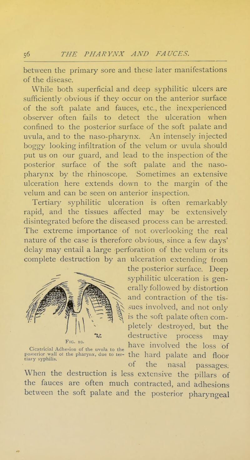 between the primary sore and these later manifestations of the disease. While both superficial and deep syphilitic ulcers are sufficiently obvious if they occur on the anterior surface of the soft palate and fauces, etc., the inexperienced observer often fails to detect the ulceration when confined to the posterior surface of the soft palate and uvula, and to the naso-pharynx. An intensely injected boggy looking infiltration of the velum or uvula should put us on our guard, and lead to the inspection of the posterior surface of the soft palate and the naso- pharynx by the rhinoscope. Sometimes an extensive ulceration here extends down to the margin of the velum and can be seen on anterior inspection. Tertiary syphilitic ulceration is often remarkably rapid, and the tissues affected may be extensively disintegrated before the diseased process can be arrested. The extreme importance of not overlooking the real nature of the case is therefore obvious, since a few days' delay may entail a large perforation of the velum or its complete destruction by an ulceration extending from the posterior surface. Deep syphilitic ulceration is gen- erally follow ed by distortion and contraction of the tis- sues involved, and not only is the soft palate often com- pletely destroyed, but the destructive process may have involved the loss of the hard palate and floor of the nasal passages. When the destruction is less extensive the pillars of the fauces are often much contracted, and adhesions between the soft palate and the posterior pharyngeal Fig. iq. Cicatricial Adhesion of the uvula to the posterior wall ol the pharynx, due to ter- tiary syphilis.