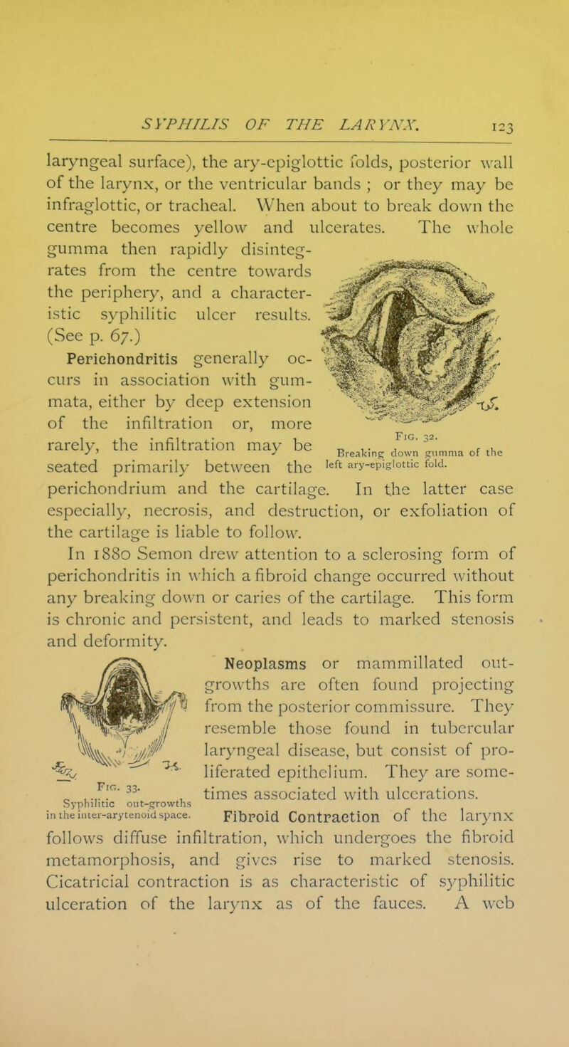 i-3 Fig. 32. Breaking down gumma of the left ary-epiglottic fold. laryngeal surface), the ary-cpiglottic folds, posterior wall of the larynx, or the ventricular bands ; or they may be infraglottic, or tracheal. When about to break down the centre becomes yellow and ulcerates. The whole gumma then rapidly disinteg- rates from the centre towards the periphery, and a character- istic syphilitic ulcer results. (See p. 67.) Perichondritis generally oc- curs in association with gum- mata, either by deep extension of the infiltration or, more rarely, the infiltration may be seated primarily between the perichondrium and the cartilage. In the latter case especially, necrosis, and destruction, or exfoliation of the cartilage is liable to follow. In 1880 Semon drew attention to a sclerosing form of perichondritis in which a fibroid change occurred without any breaking down or caries of the cartilage. This form is chronic and persistent, and leads to marked stenosis and deformity. Neoplasms or mammillated out- growths are often found projecting from the posterior commissure. They resemble those found in tubercular laryngeal disease, but consist of pro- liferated epithelium. They are some- times associated with ulcerations. Fibroid Contraction of the larynx follows diffuse infiltration, which undergoes the fibroid metamorphosis, and gives rise to marked stenosis. Cicatricial contraction is as characteristic of syphilitic ulceration of the larynx as of the fauces. A web Fir,. 33. Syphilitic out-growths in the iiiter-arytenoid space.