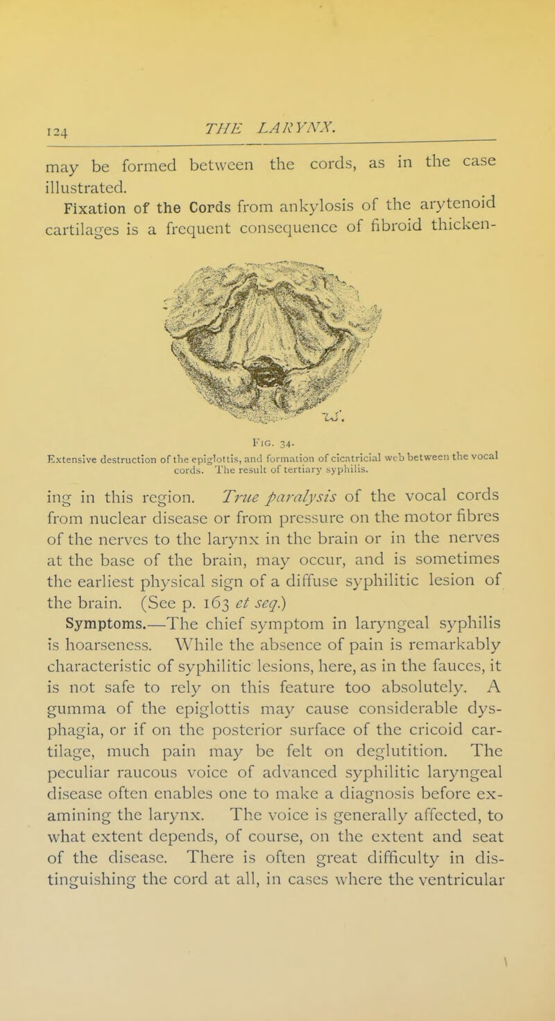 may be formed between the cords, as in the case illustrated. Fixation of the Cords from ankylosis of the arytenoid cartilages is a frequent consequence of fibroid thicken- FlG. 34. Extensive destruction of the epiglottis, and formation of cicatricial web between the vocal cords. The result of tertiary syphilis. ing in this region. True paralysis of the vocal cords from nuclear disease or from pressure on the motor fibres of the nerves to the larynx in the brain or in the nerves at the base of the brain, may occur, and is sometimes the earliest physical sign of a diffuse syphilitic lesion of the brain. (See p. 163 et seq.) Symptoms.—The chief symptom in laryngeal syphilis is hoarseness. While the absence of pain is remarkably characteristic of syphilitic lesions, here, as in the fauces, it is not safe to rely on this feature too absolutely. A gumma of the epiglottis may cause considerable dys- phagia, or if on the posterior surface of the cricoid car- tilage, much pain may be felt on deglutition. The peculiar raucous voice of advanced syphilitic laryngeal disease often enables one to make a diagnosis before ex- amining the larynx. The voice is generally affected, to what extent depends, of course, on the extent and seat of the disease. There is often great difficulty in dis- tinguishing the cord at all, in cases where the ventricular \